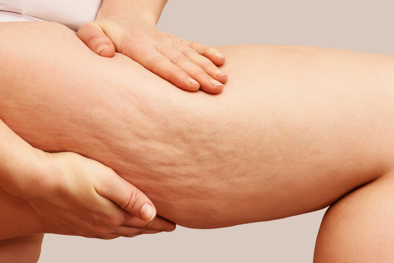 Morpheus8 for Cellulite: Does It Really Work?