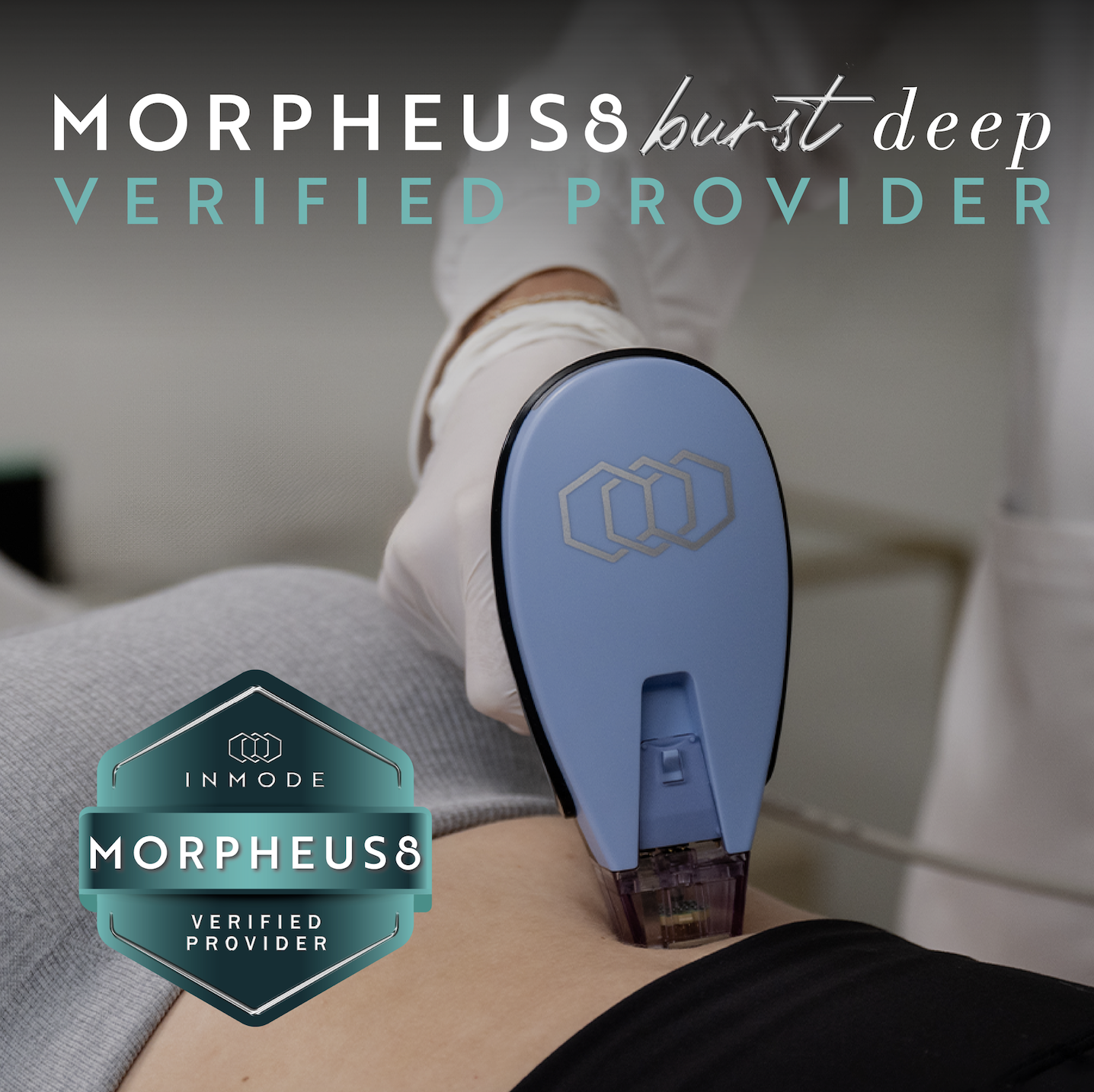 A person receiving a cosmetic or medical treatment using a blue device on their abdomen, with text overlay indicating 'Morpheus8 burst deep verified provider' and a Morpheus8 verified provider badge.