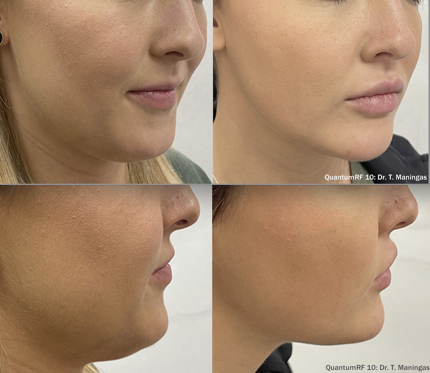 Close-up images of a woman's face showing the before and after effects of a skin treatment. The top row displays the initial condition, and the bottom row shows the improved skin quality after treatment.