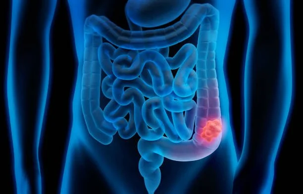 Colon/Bowel Surgery