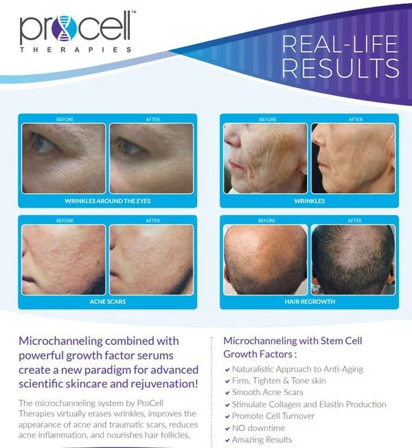 Promotional poster for ProCell Therapies showing before and after images of skin treatment results, including reduced wrinkles around the eyes and chin, fewer acne scars, and hair regrowth. The poster highlights microchanneling combined with stem cell growth factors for skin rejuvenation.