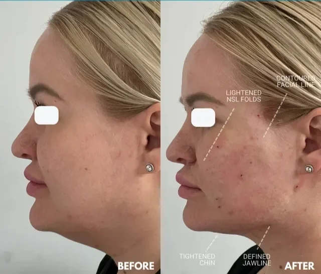 Side-by-side comparison of a woman's face showing skin improvement after treatment. The 'before' image shows clearer skin, while the 'after' image shows textured skin with marked areas indicating lightened NSL folds, contoured facial line, tightened