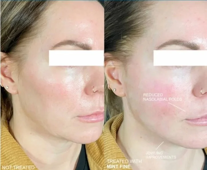 Comparison of a woman's face showing before and after skincare treatment, highlighting reduced nasolabial folds and improved jawline, with annotations indicating effects of mint fine treatment.