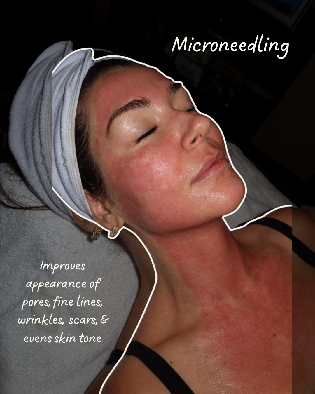 Close-up of a woman receiving microneedling treatment on her face, with skin redness and visible pores, lying down with her eyes closed, wearing a headband and black tank top.