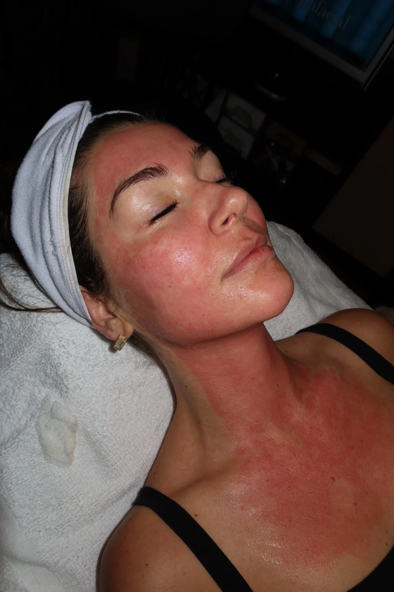 Microneedling Neck Chest Treatment Chicago Lakeview