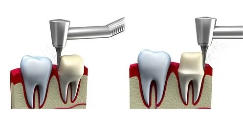 Crown steps made simple: 🦷✨ prepare the tooth, capture a digital scan 📸, design the crown 💻, and cement it in place. With our same-day CEREC technology, your custom crown is made right here in-office&mdash;no temporary needed. 🙌

👉 Save this pos