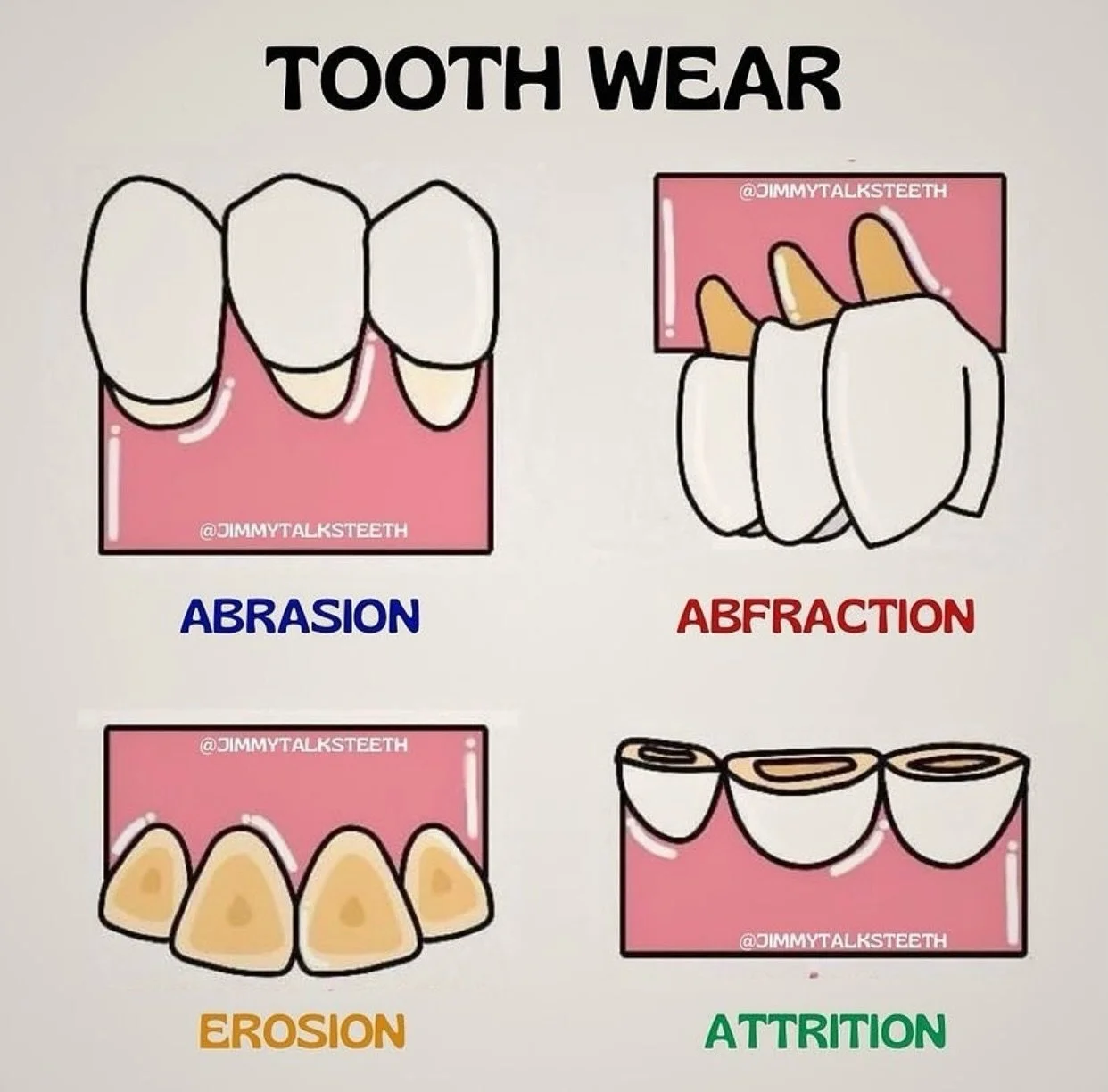 Tooth wear isn&rsquo;t one-size-fits-all 🦷
There are four main types&mdash;and knowing the difference matters:

▫️ Abrasion &ndash; mechanical wear (think aggressive brushing or abrasive toothpaste)
▫️ Abfraction &ndash; stress-related lesions from 