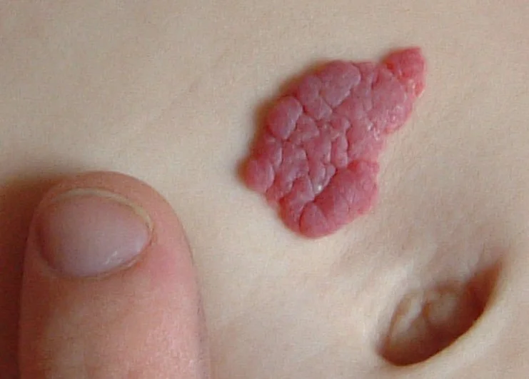 Capillary_haemangioma.jpg
