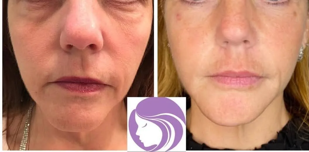 A&M-Clinical-Beauty-radiesse