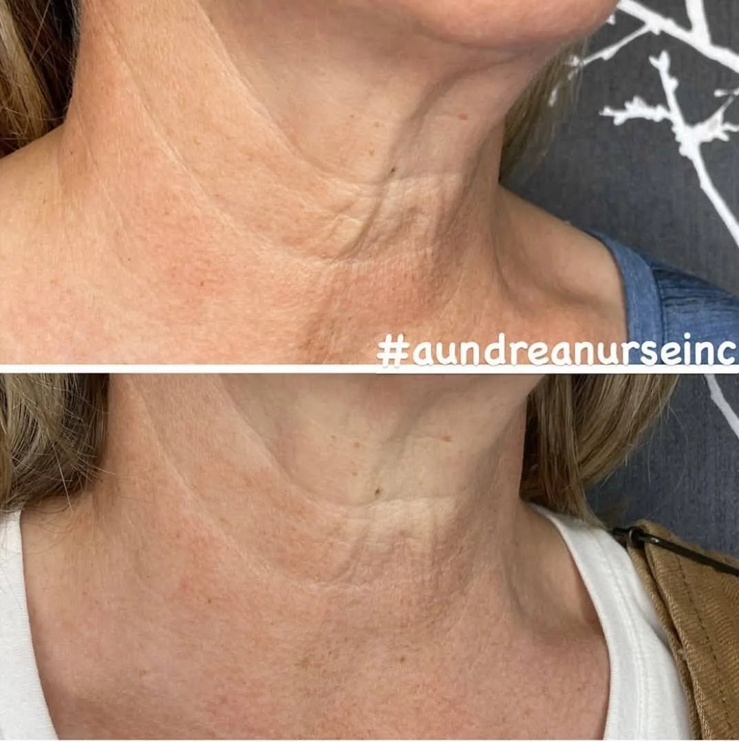 A&M-Clinical-Beauty-radiesse