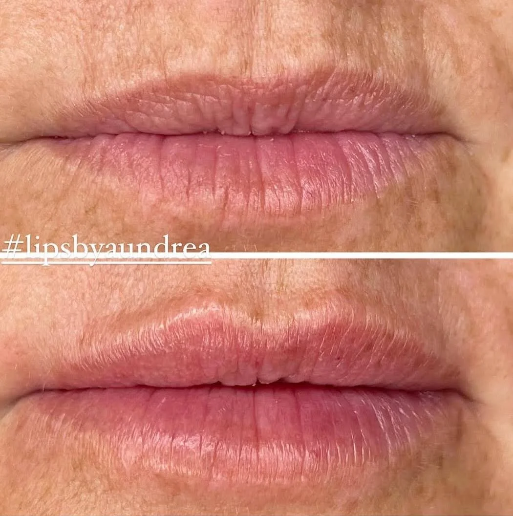 A&M-Clinical-Beauty-filler-eye