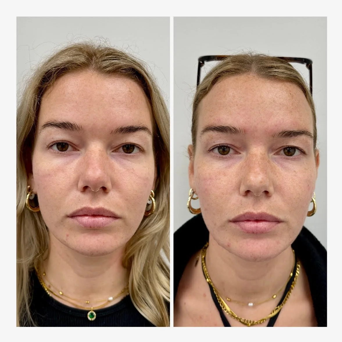 A&M-Clinical-Beauty-filler-face