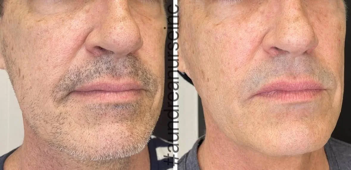 A&M-Clinical-Beauty-Sculptra