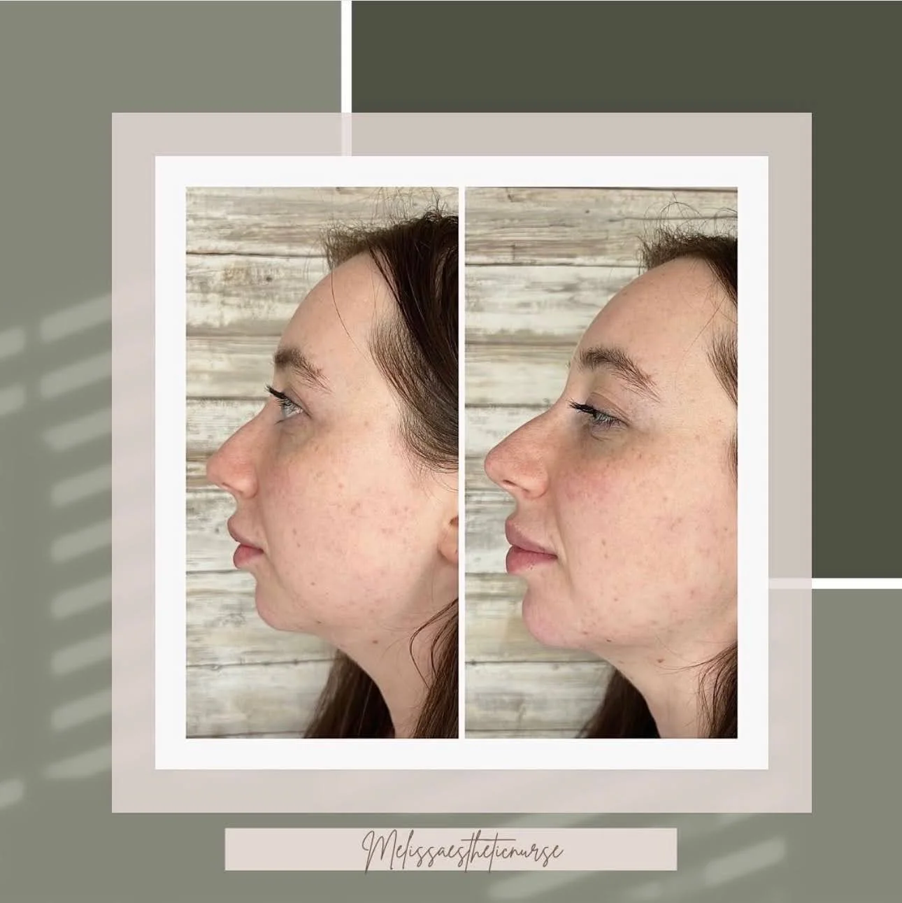 A&M-Clinical-Beauty-filler-face