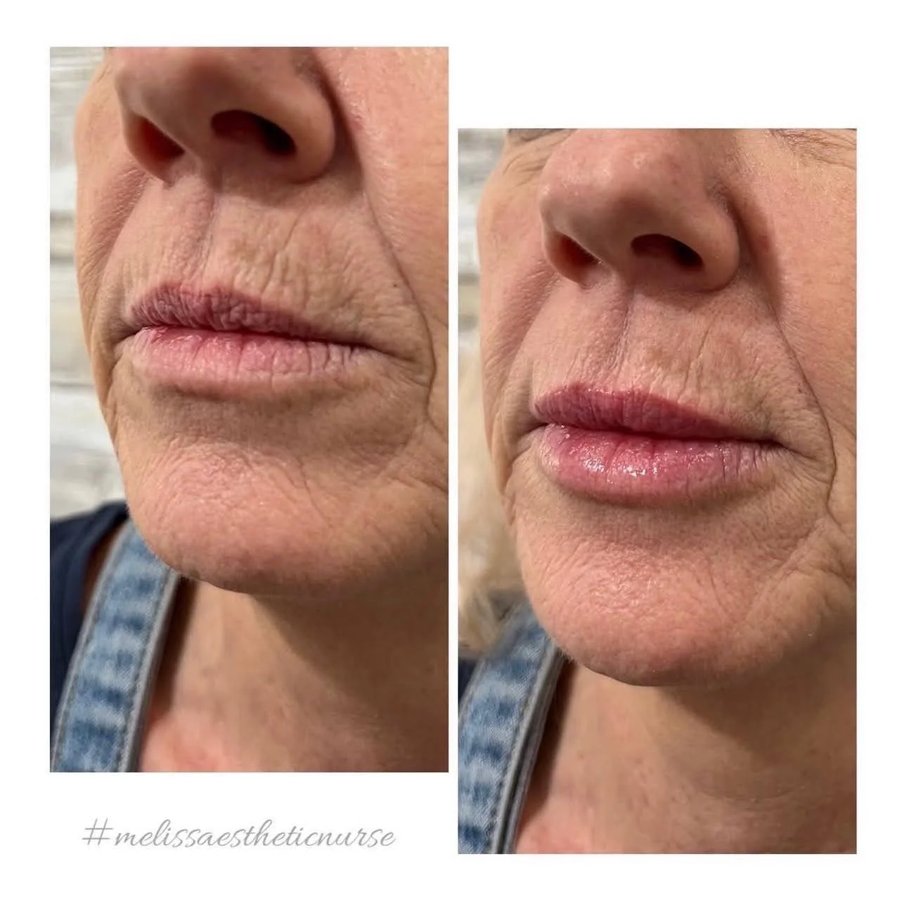 A&M-Clinical-Beauty-filler-face