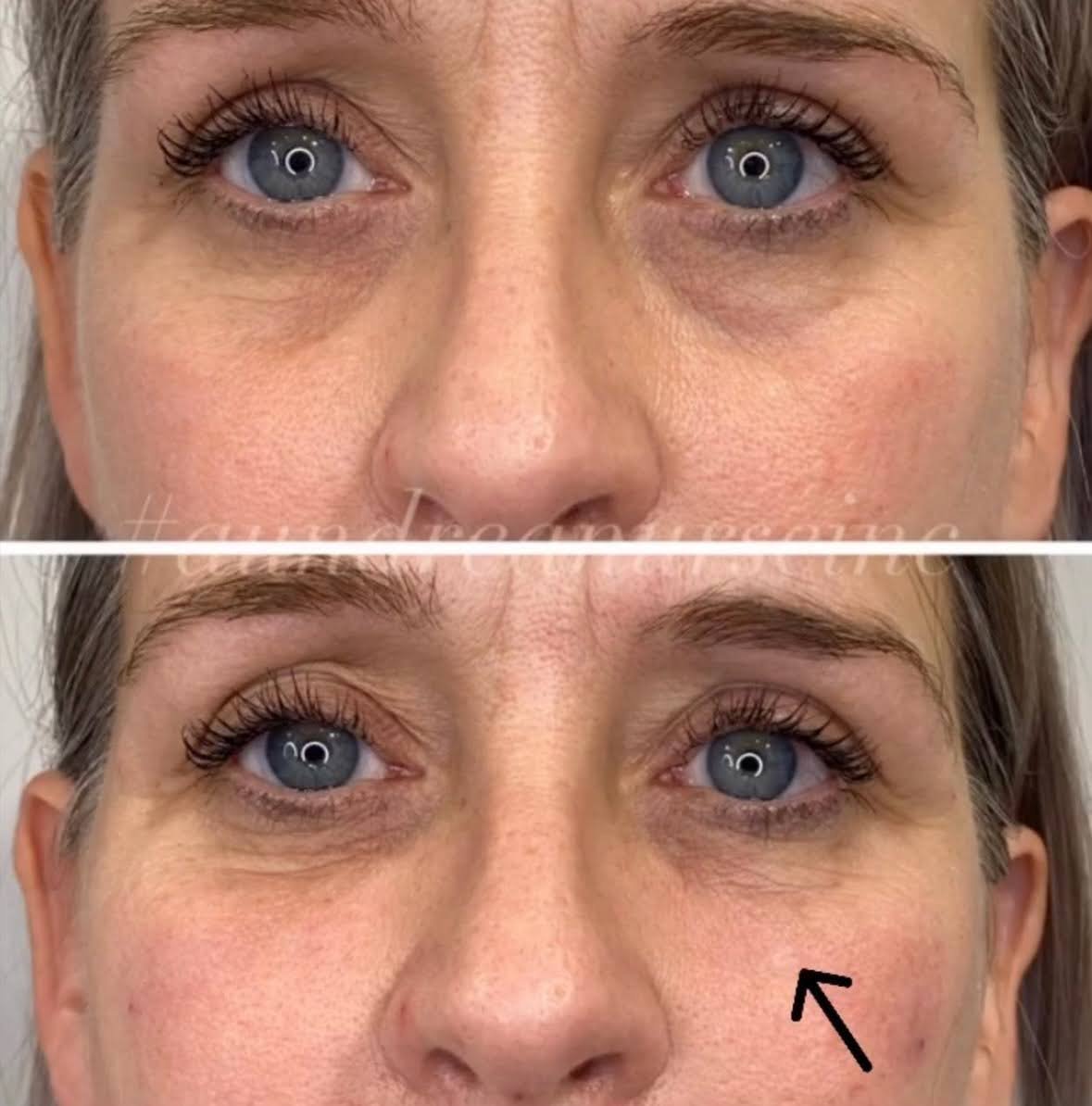 A&M-Clinical-Beauty-filler-eye