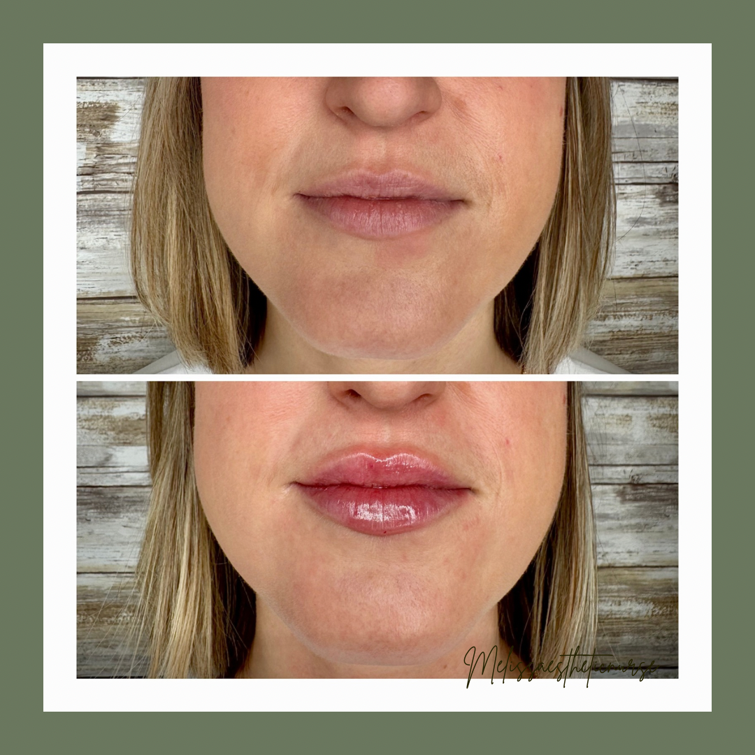 A&M-Clinical-Beauty-filler-face