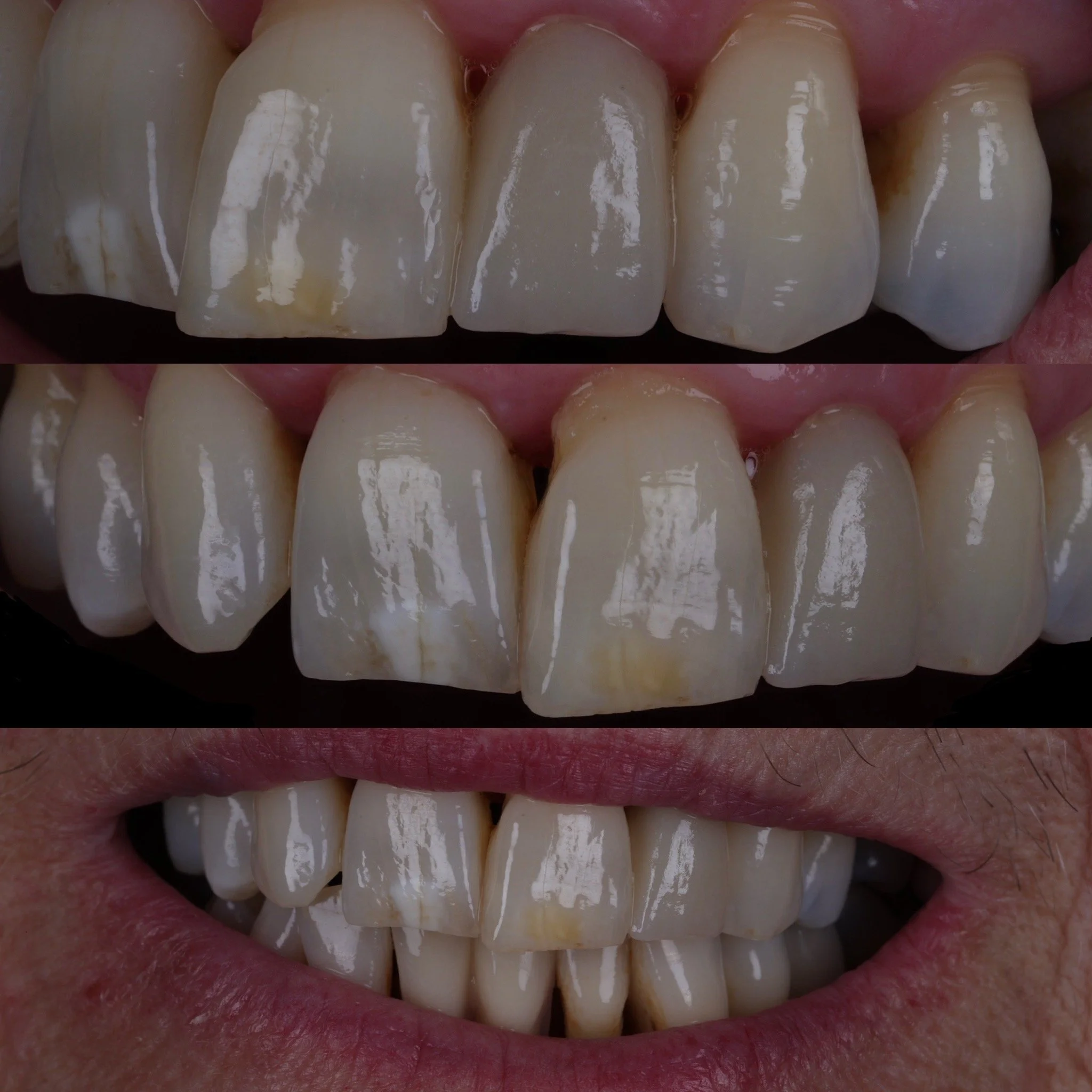 Upper lateral incisor single crown