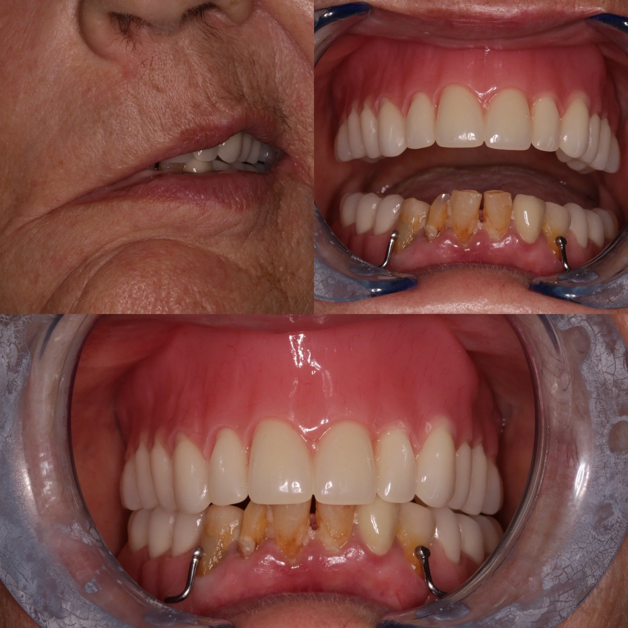 Part 2 of a complex denture case. See final denture in situ with retention.