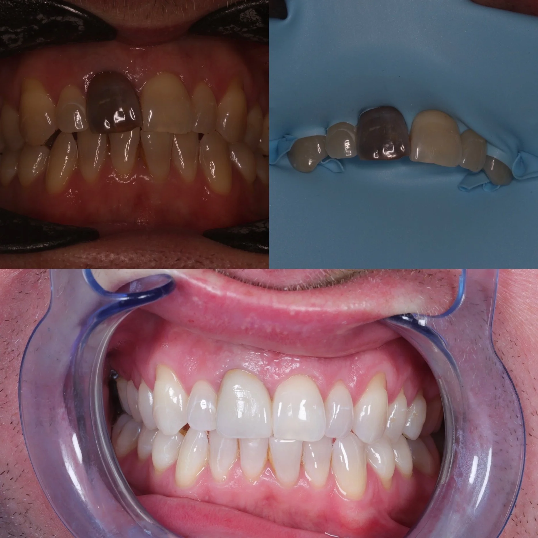 Discoloured root filled tooth, internal/exterrnal bleaching initially to improve stump shade and layered zirconia crown