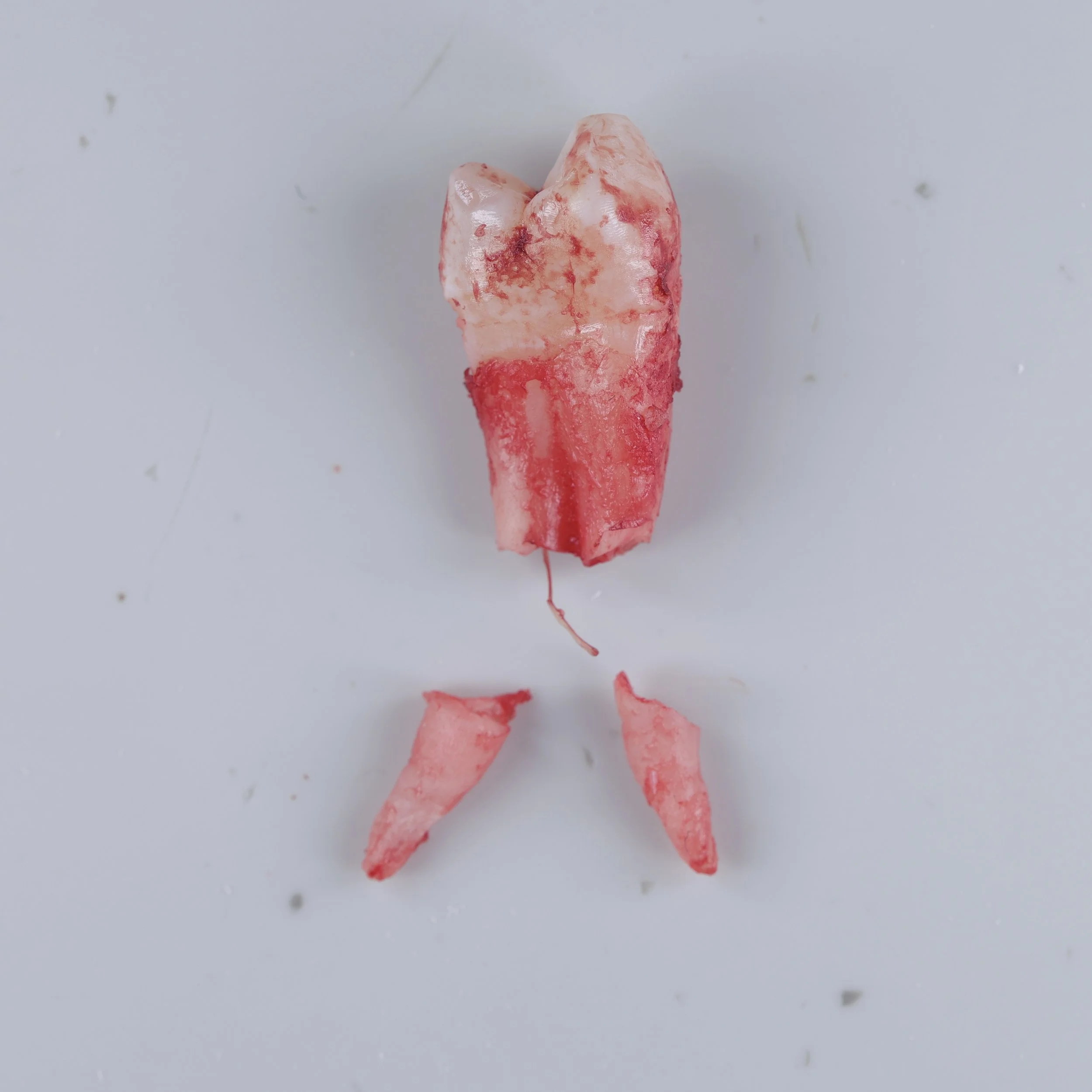 Tricky ortho extraction where both roots fractured and were retrieved