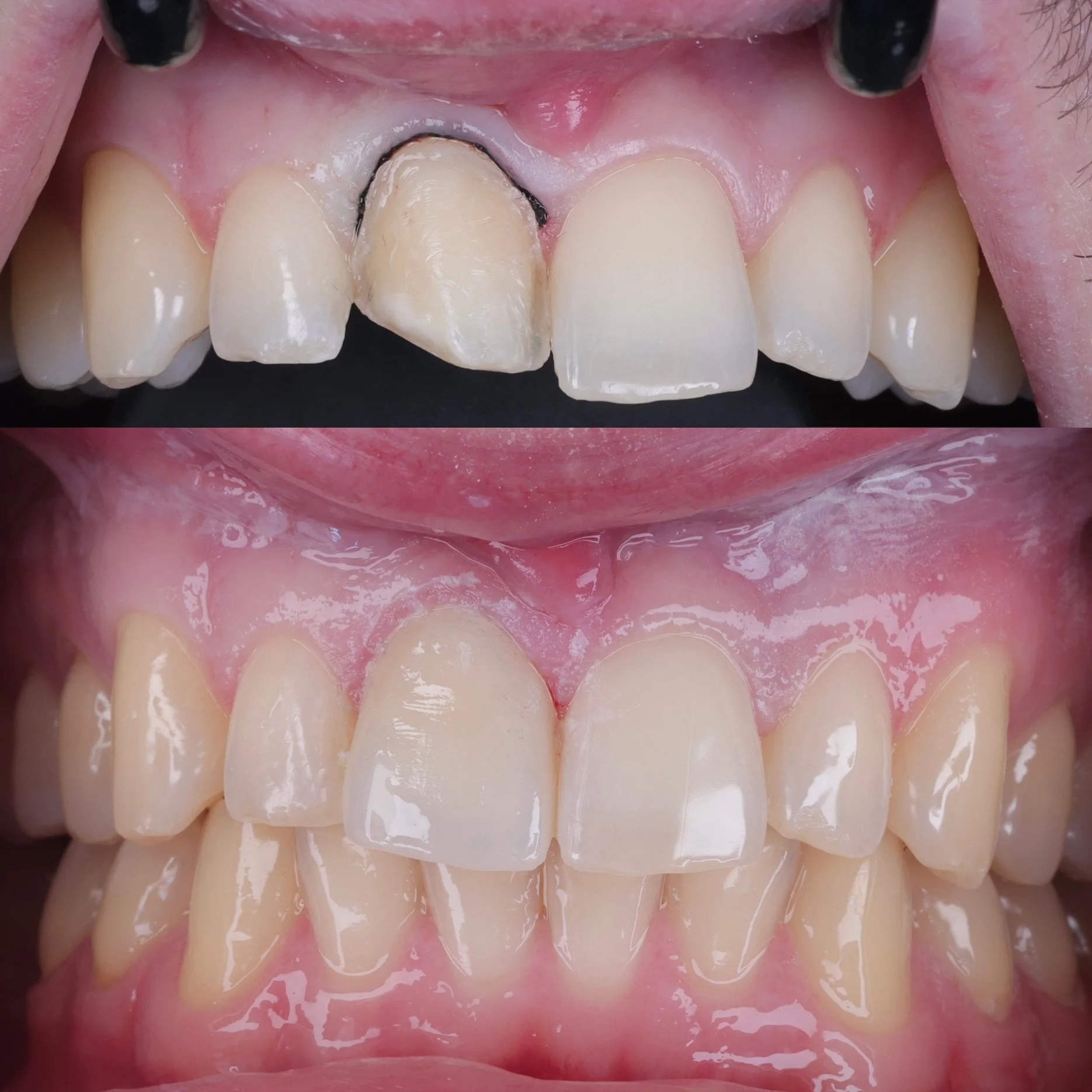 Single tooth veneer after previous trauma