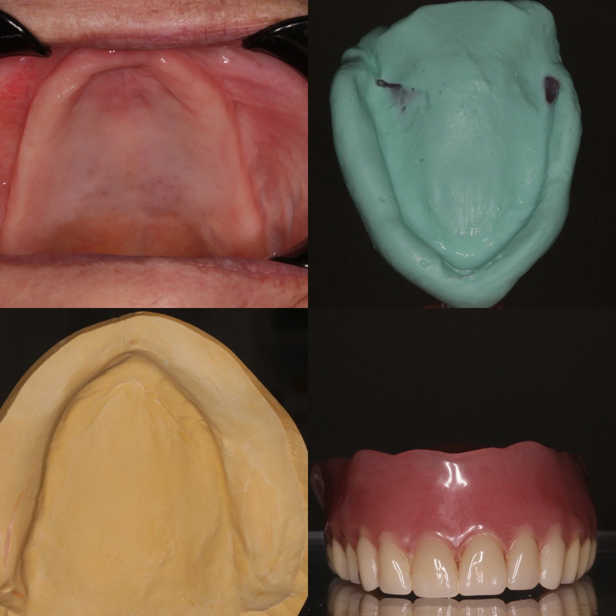 Part 1 of a complex denture case. Facial palsy present with extremely resorbed alveolar ridge and severe xerostomia, upper master impression.