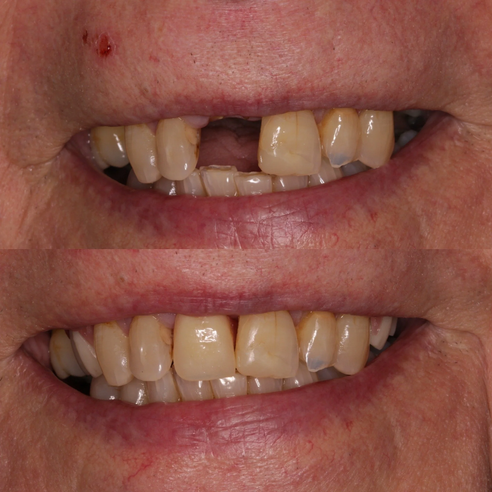 Characterised front tooth on denture