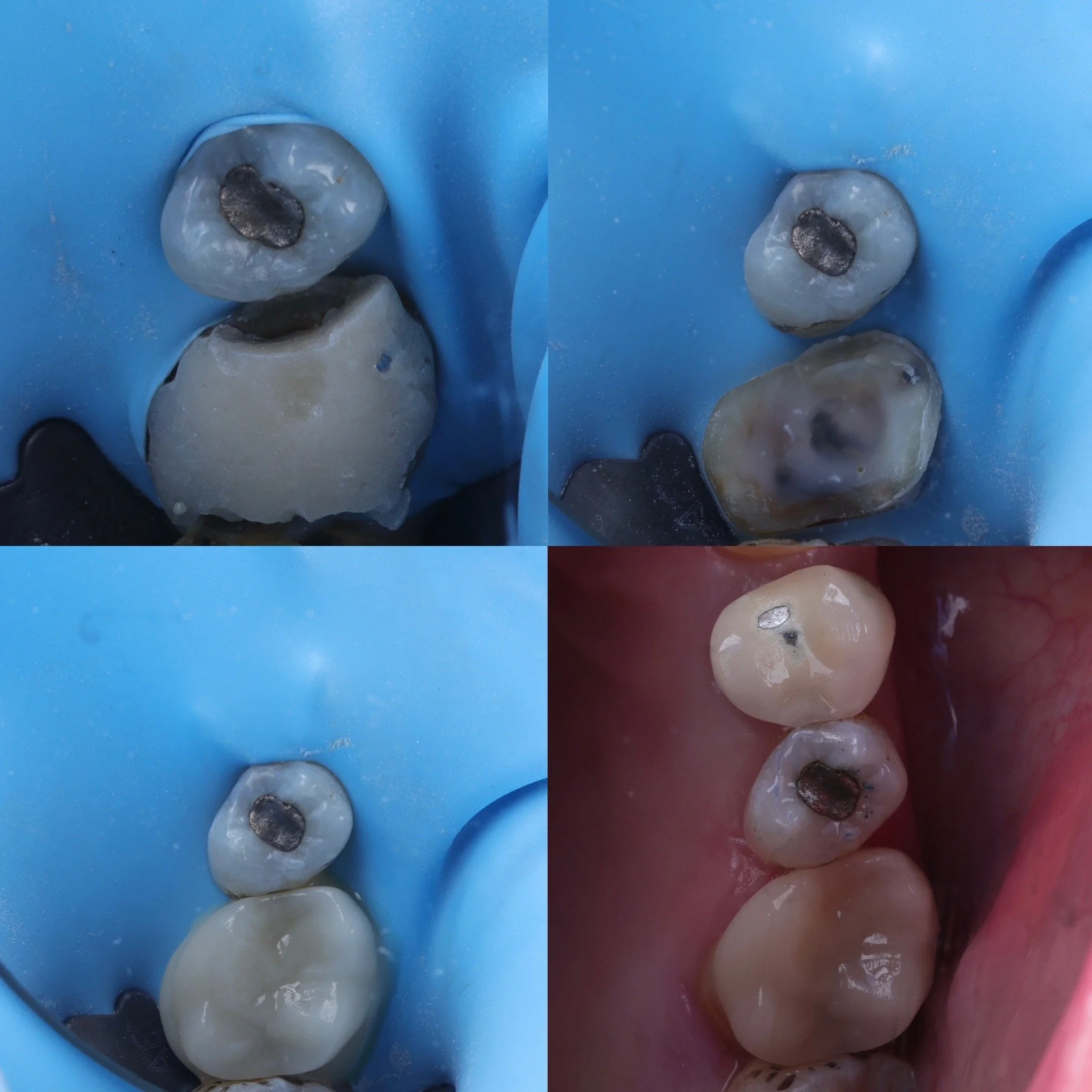 Last chance bonded overlay on heavily broken down tooth