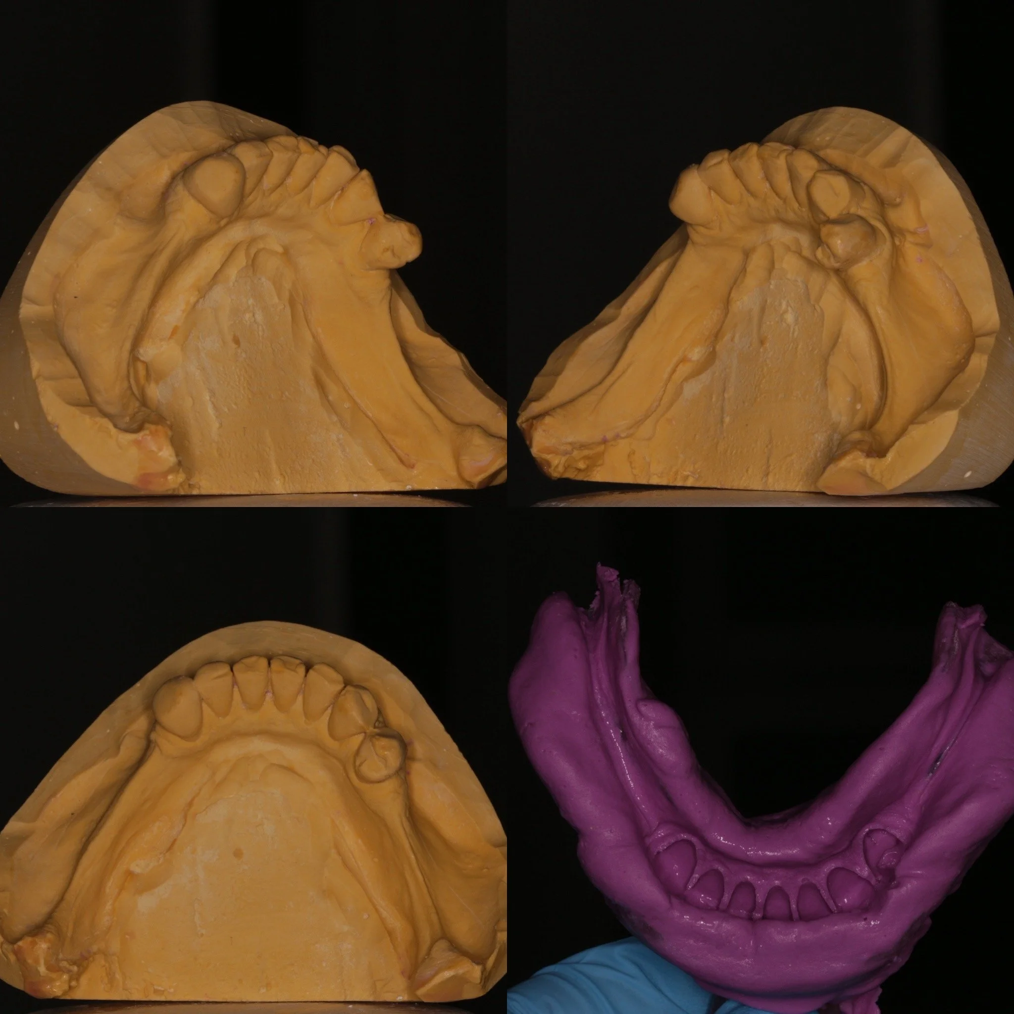 Master impression and casts