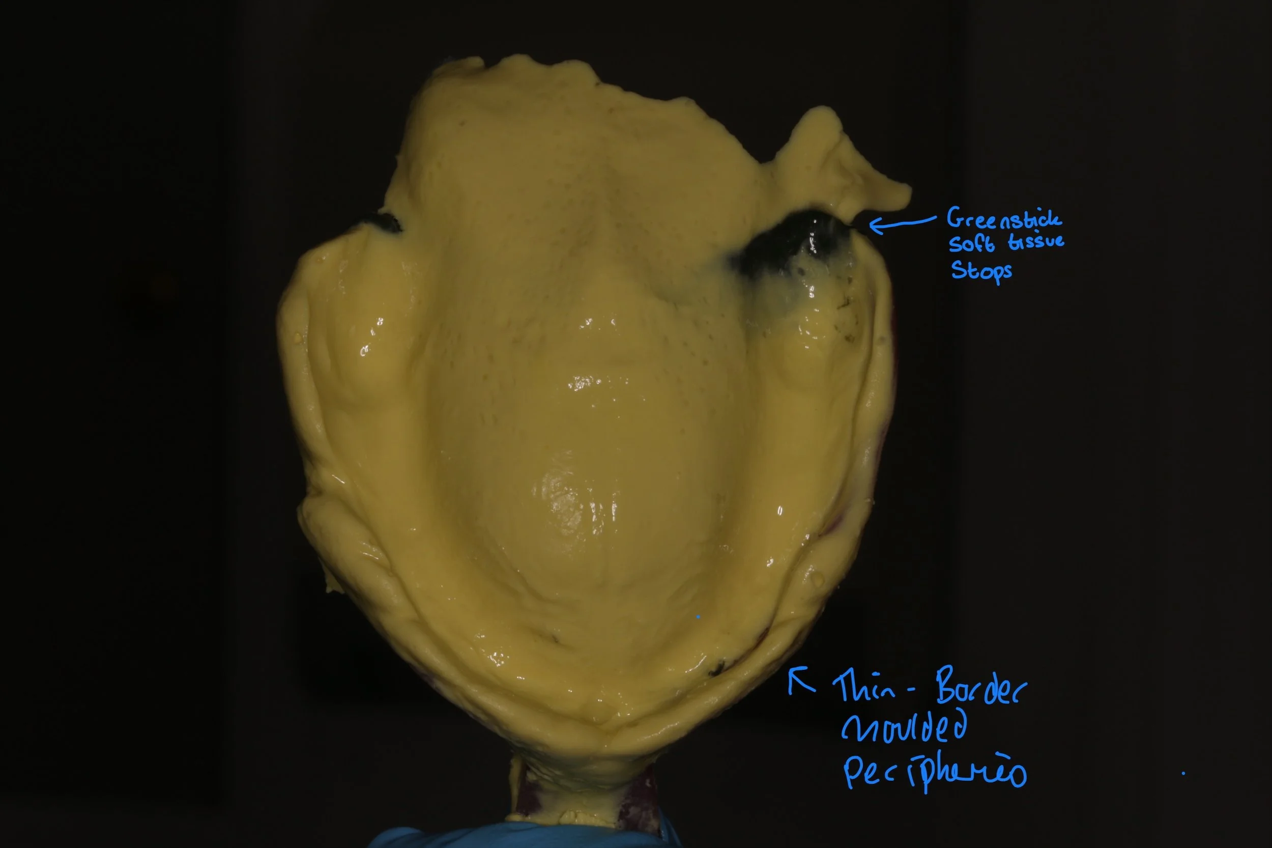 Master impression using alginate