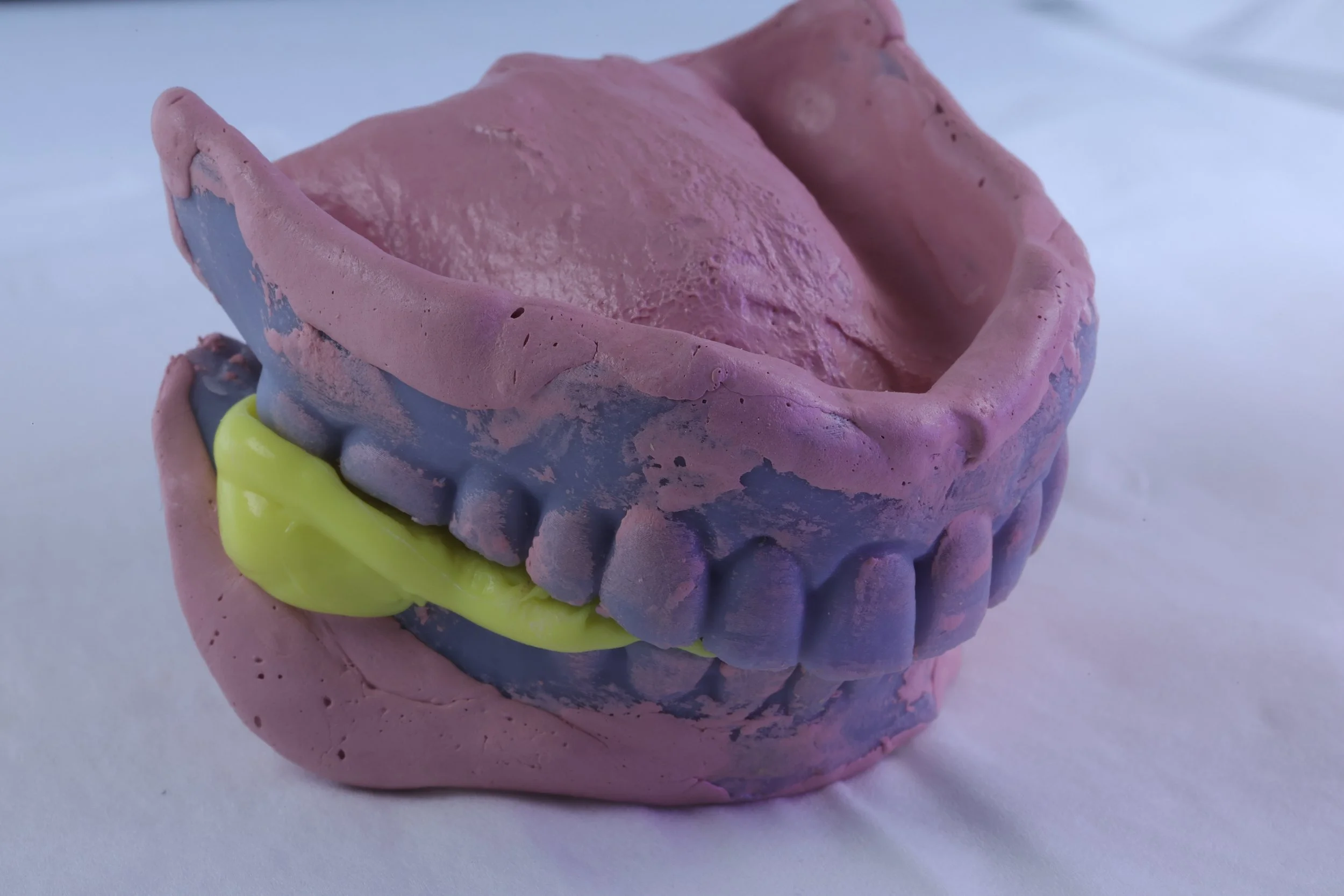 ZnOE reline in a 3d printed copy denture technique
