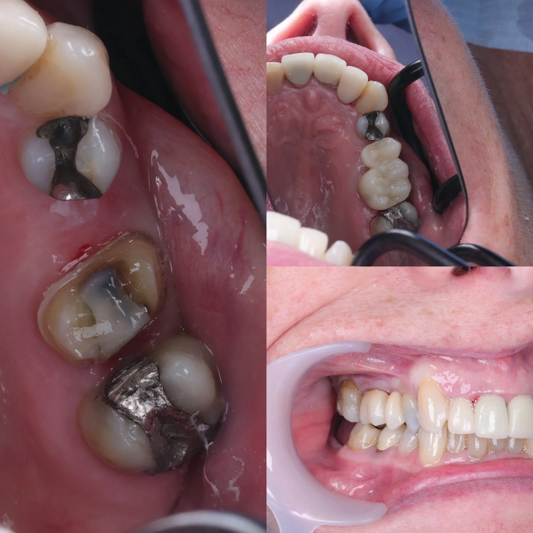 Conventional cantilever bridge off heavily restored first molar replacing a premolar