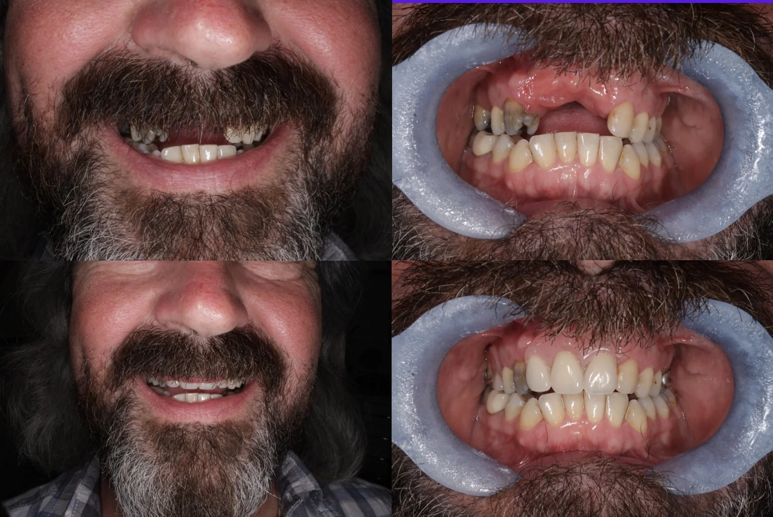 Chrome denture replacing upper anterior teeth