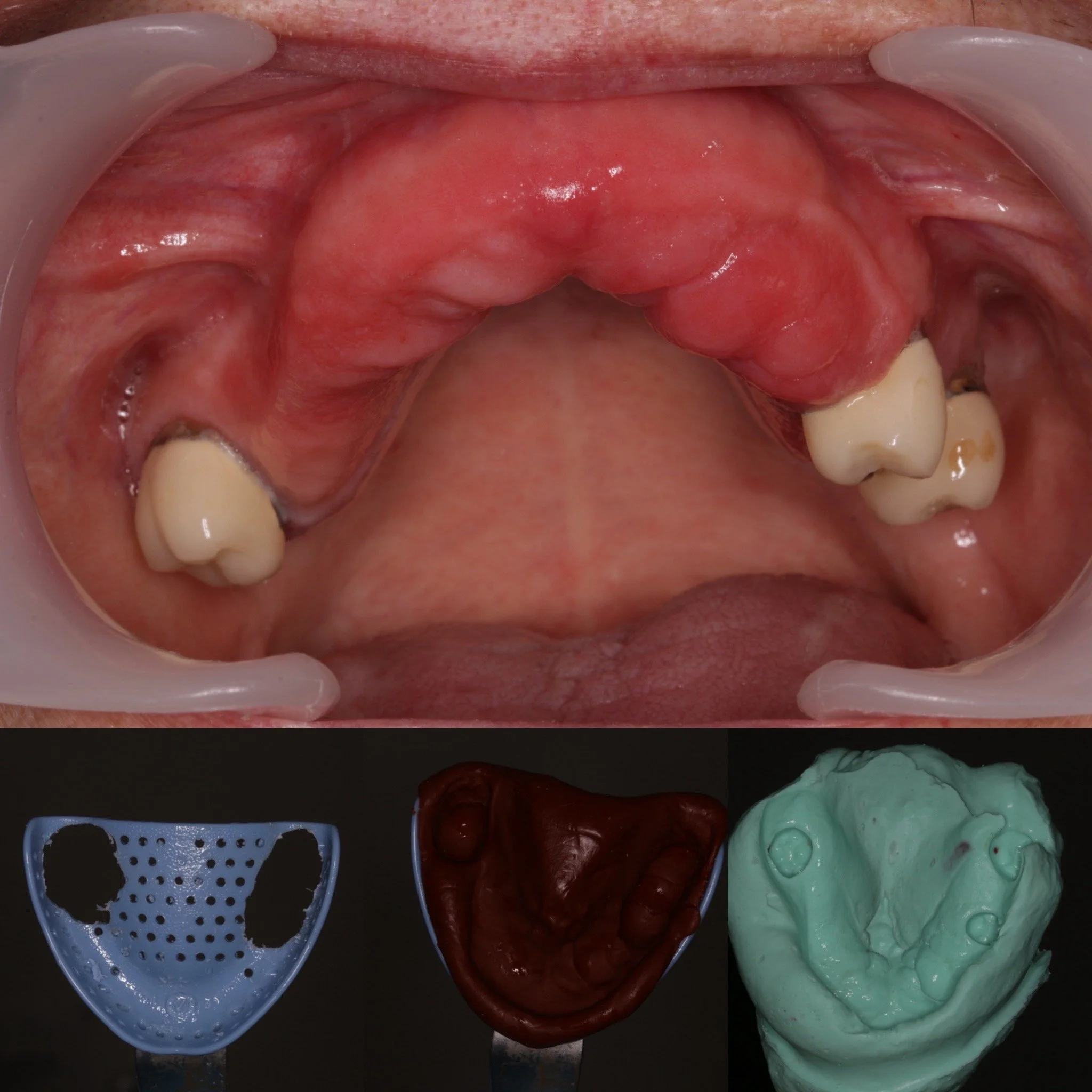 Part 1 - complex flabby ridge impression, primary impressions
