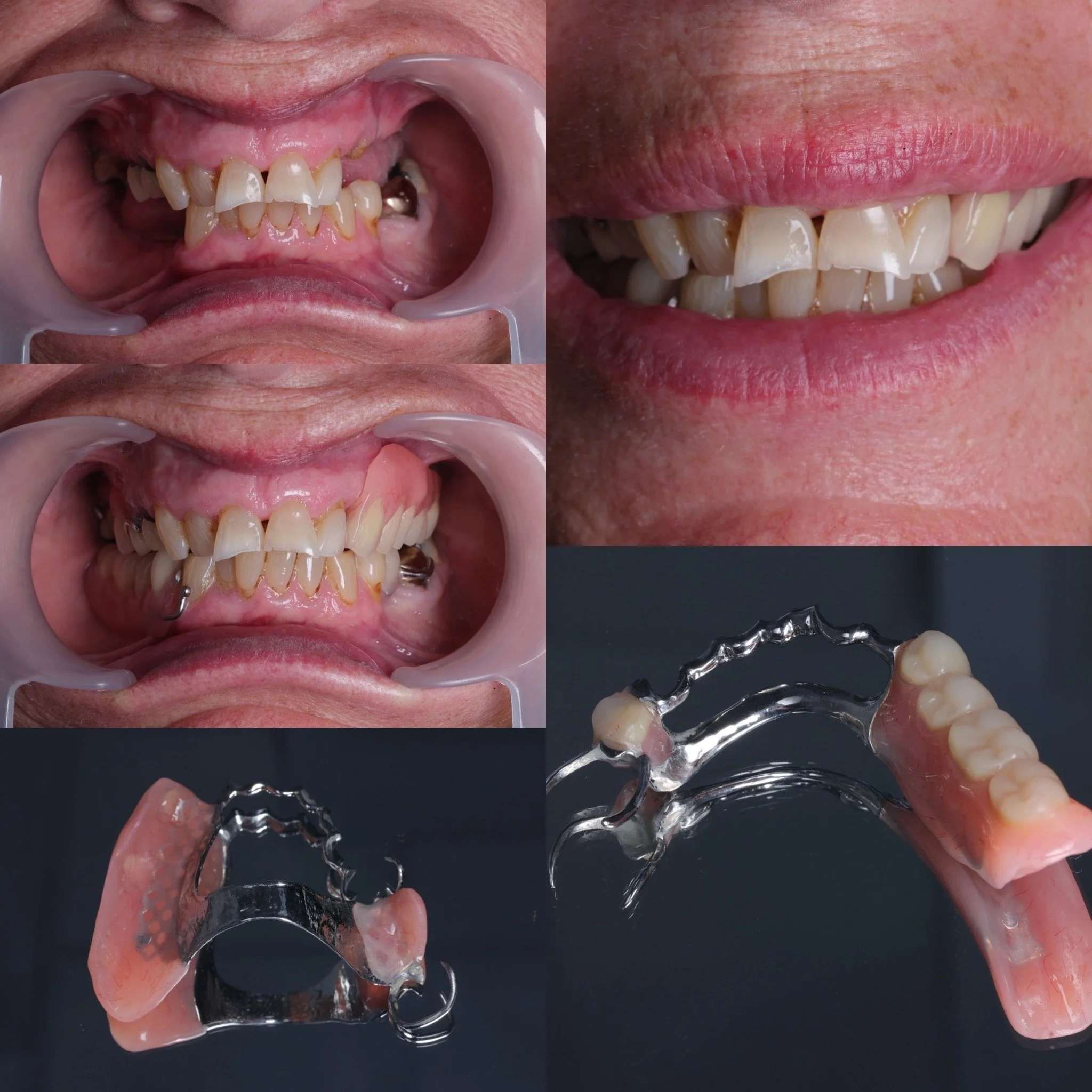 Two chrome dentures reorganising bite prior to fixed restorative in a complex wear case, Scandinavian principles followed