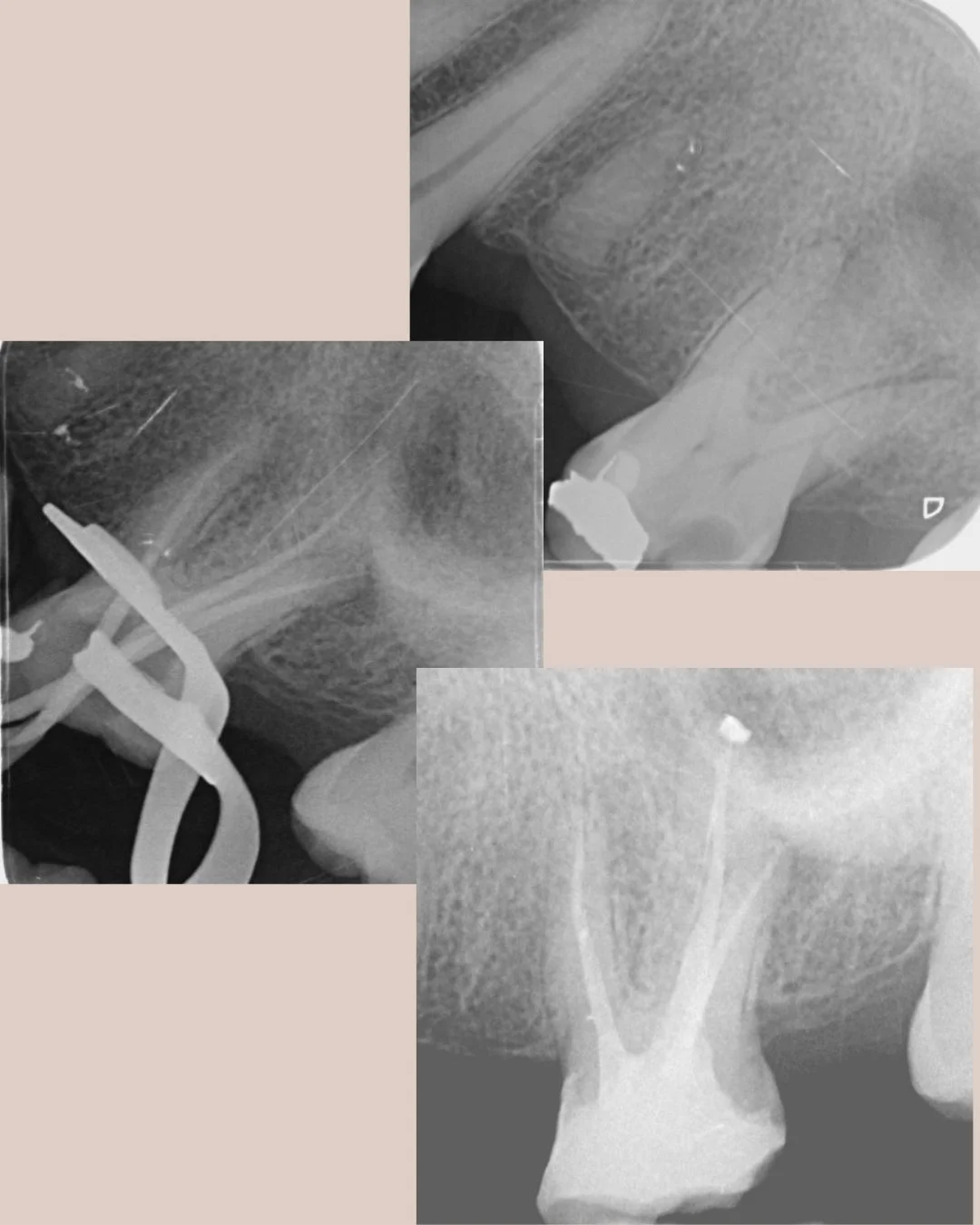 Upper first molar completed in 1 stage