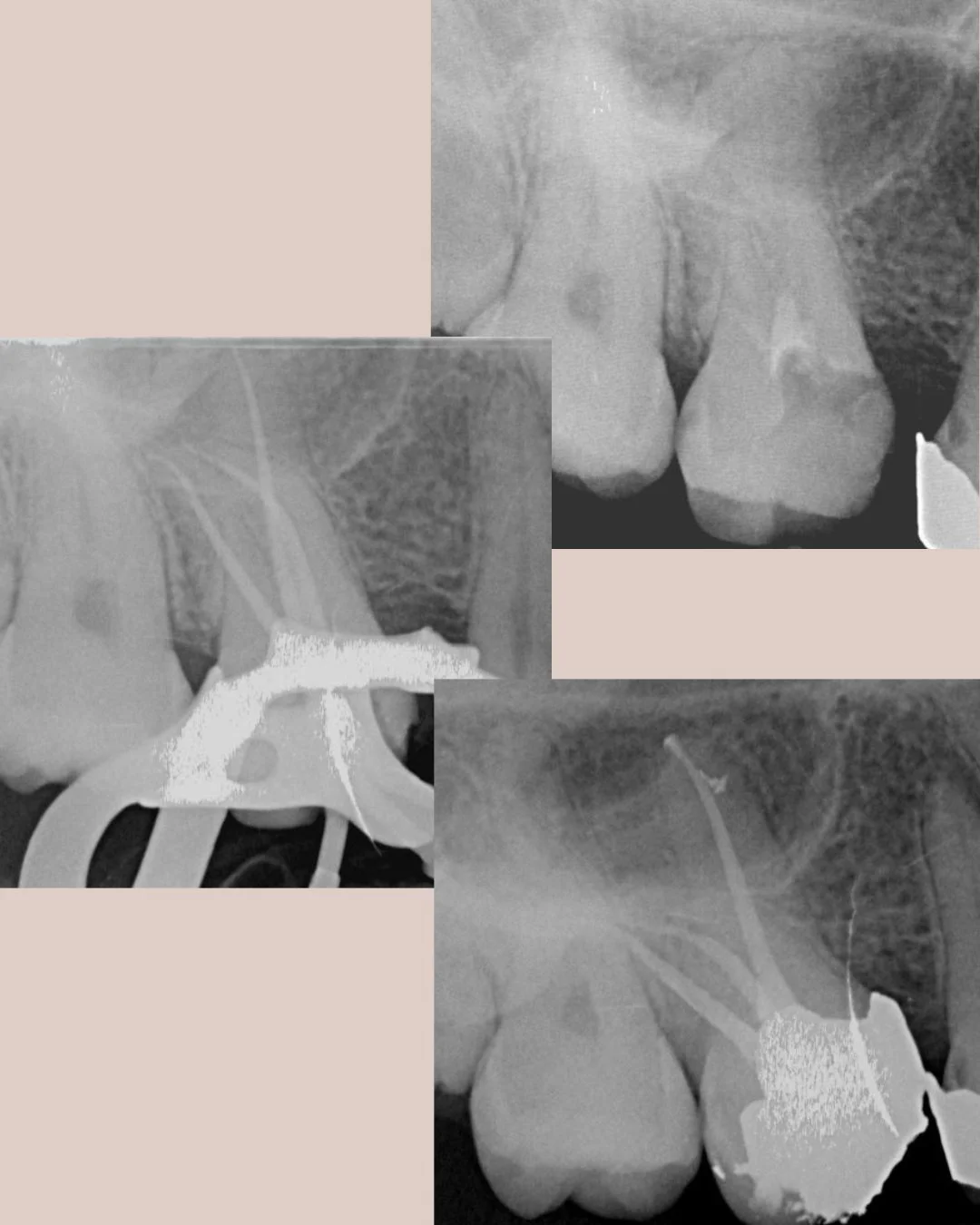 Upper molar with tricky root position