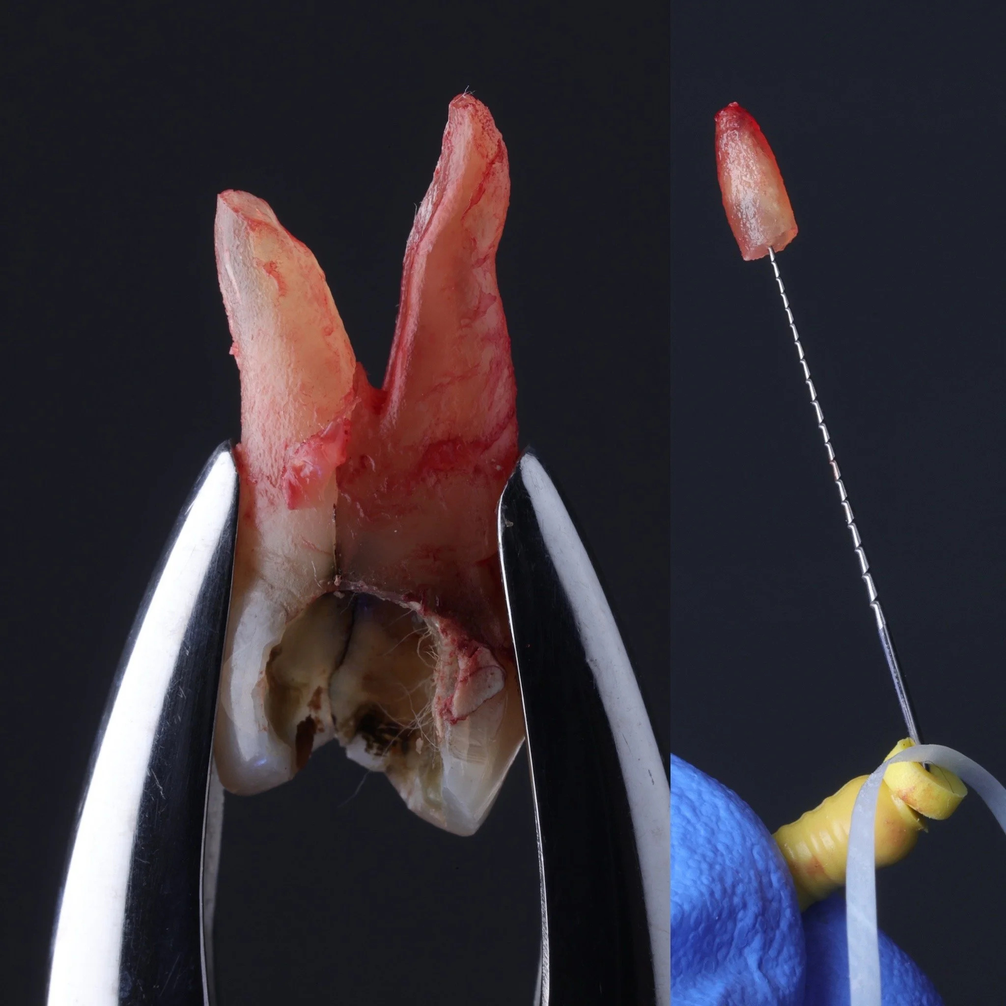 Vertical root fracture tooth, root tip fractured and retrieved with Hedstrom file