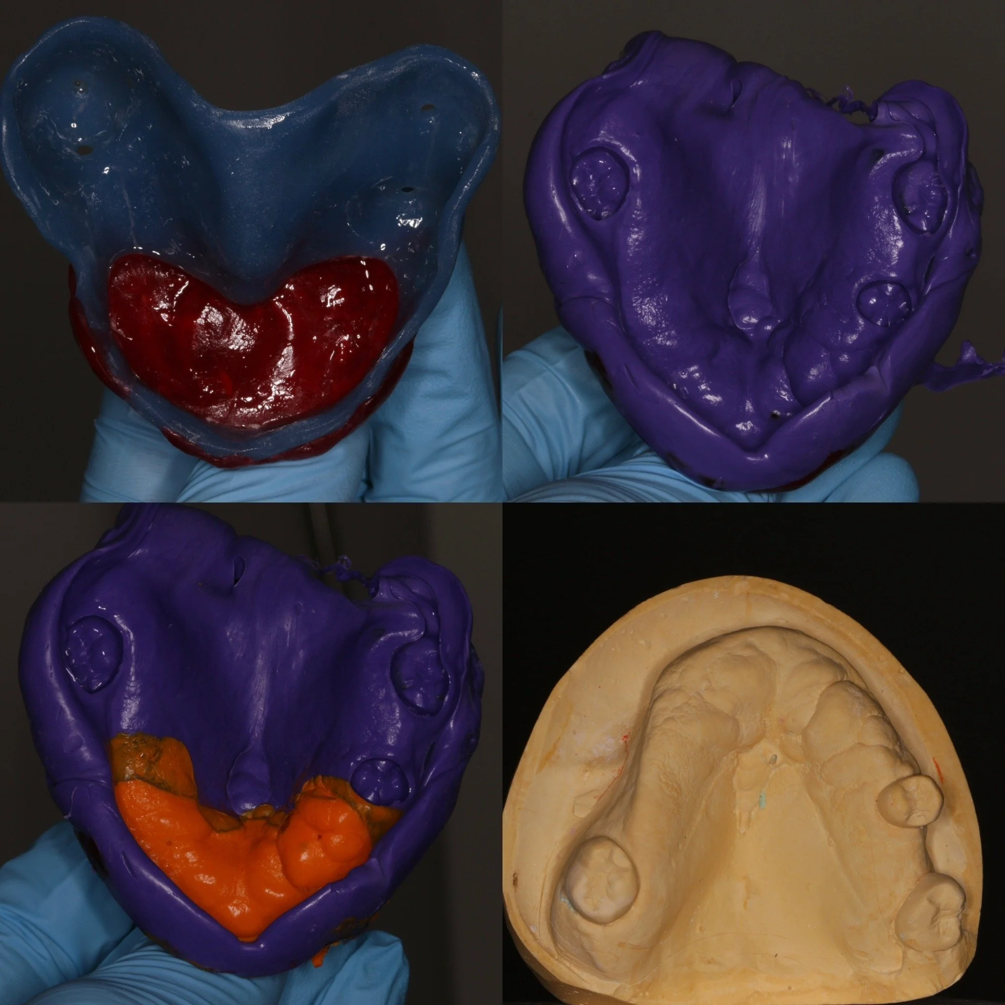 Part 2 - final impression using modified window technique and silicone