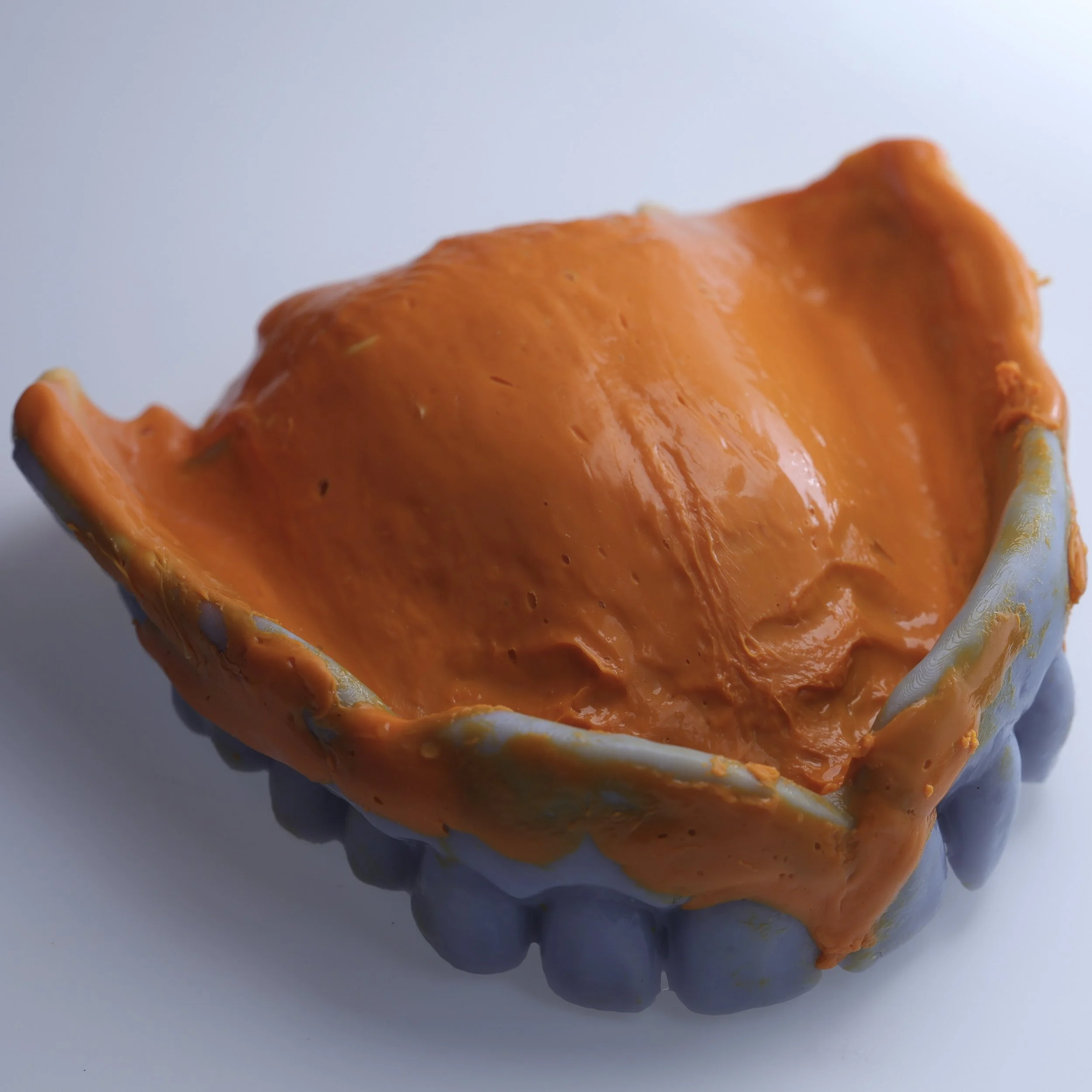 Silicone reline impression in 3d printed copy denture technqiue