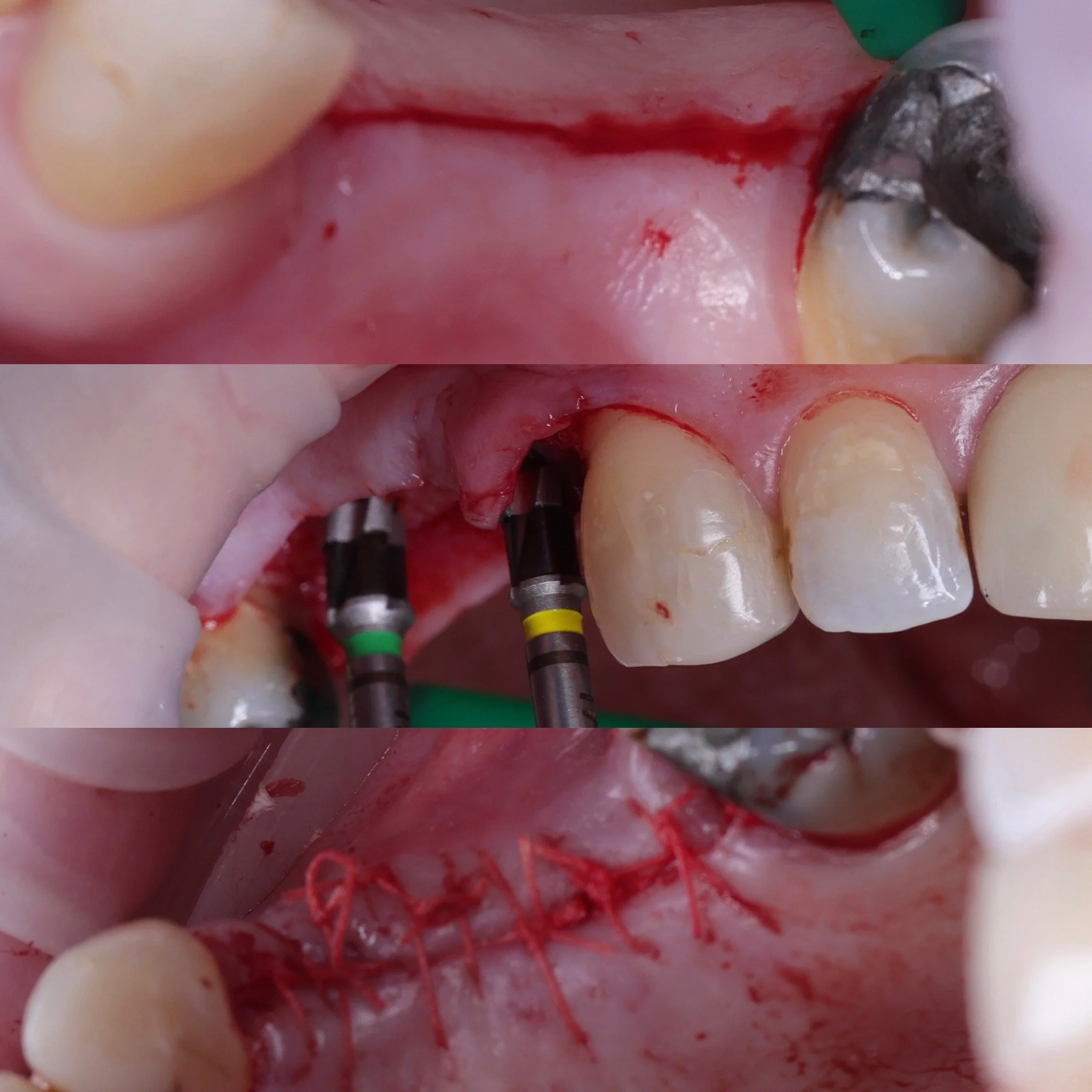 First implant bridge placement from UR4 - UR6, tension free closure