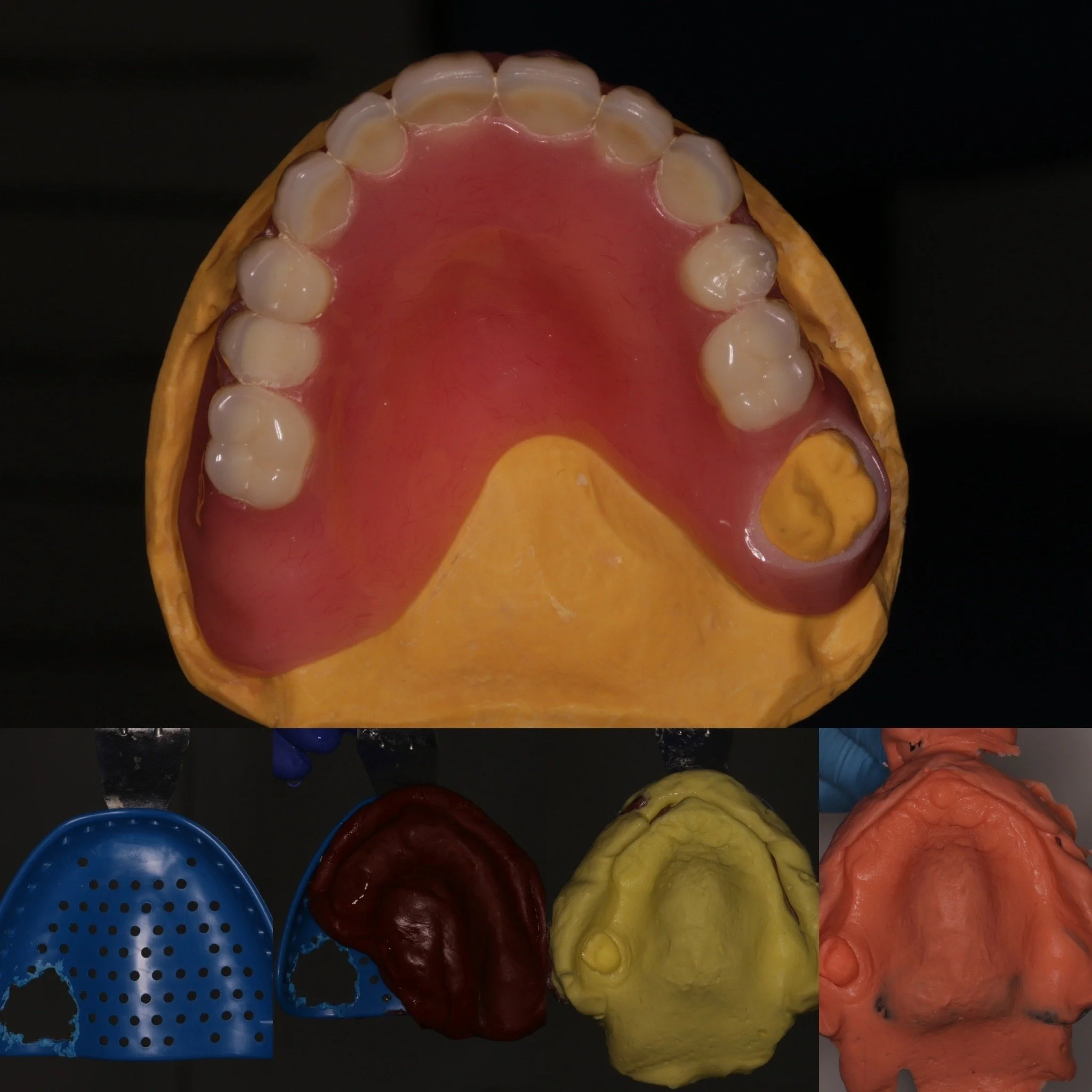 A gasket dentuire where a patient has a strong remaining upper molar, achieved excellent retention through POI.