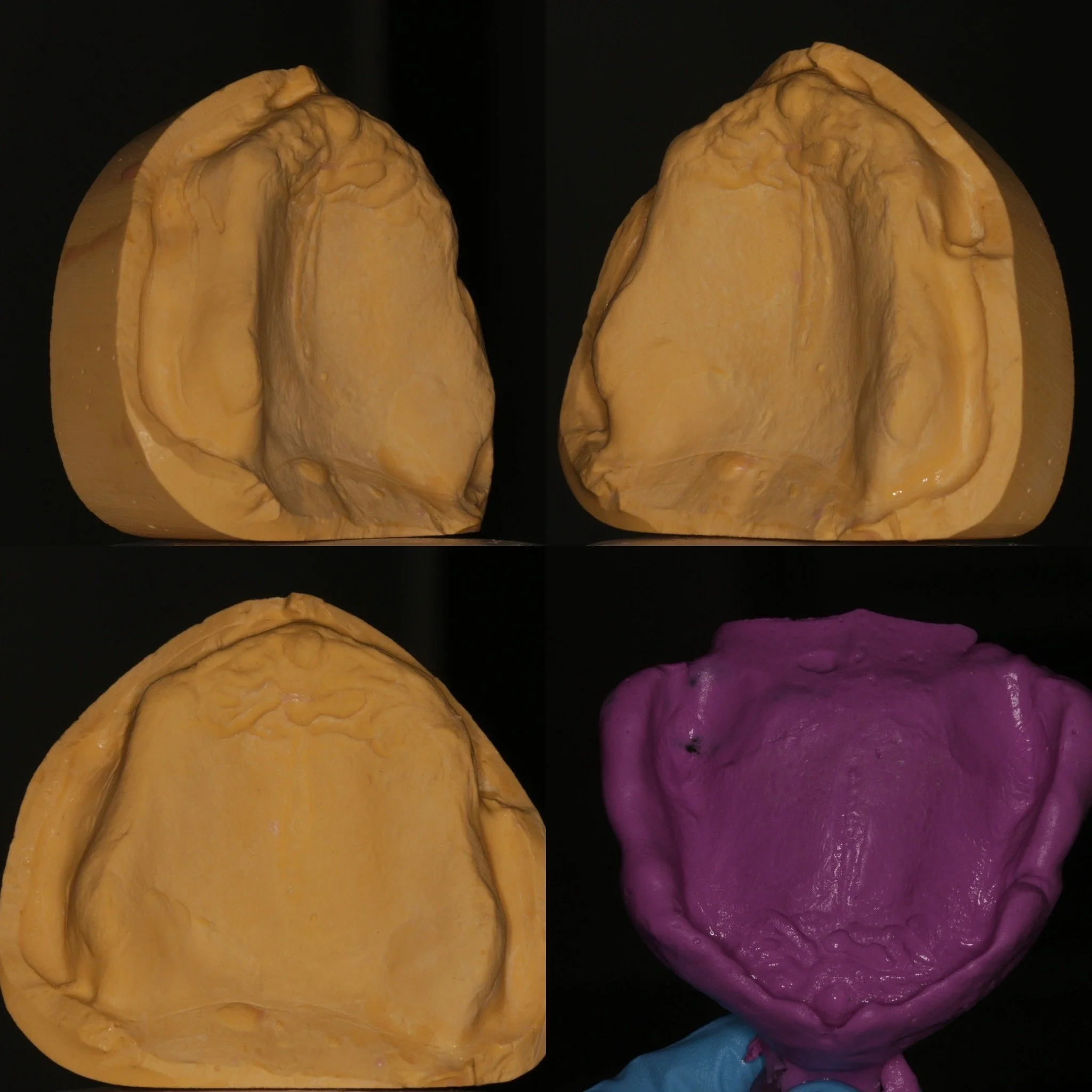 Master impression and casts