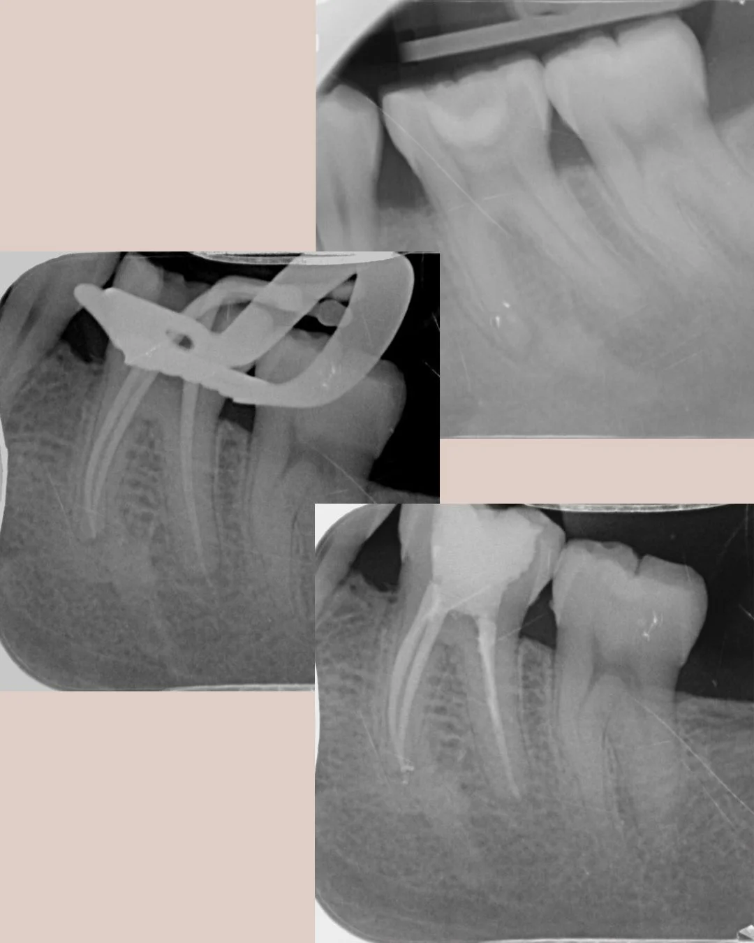 Lower molar