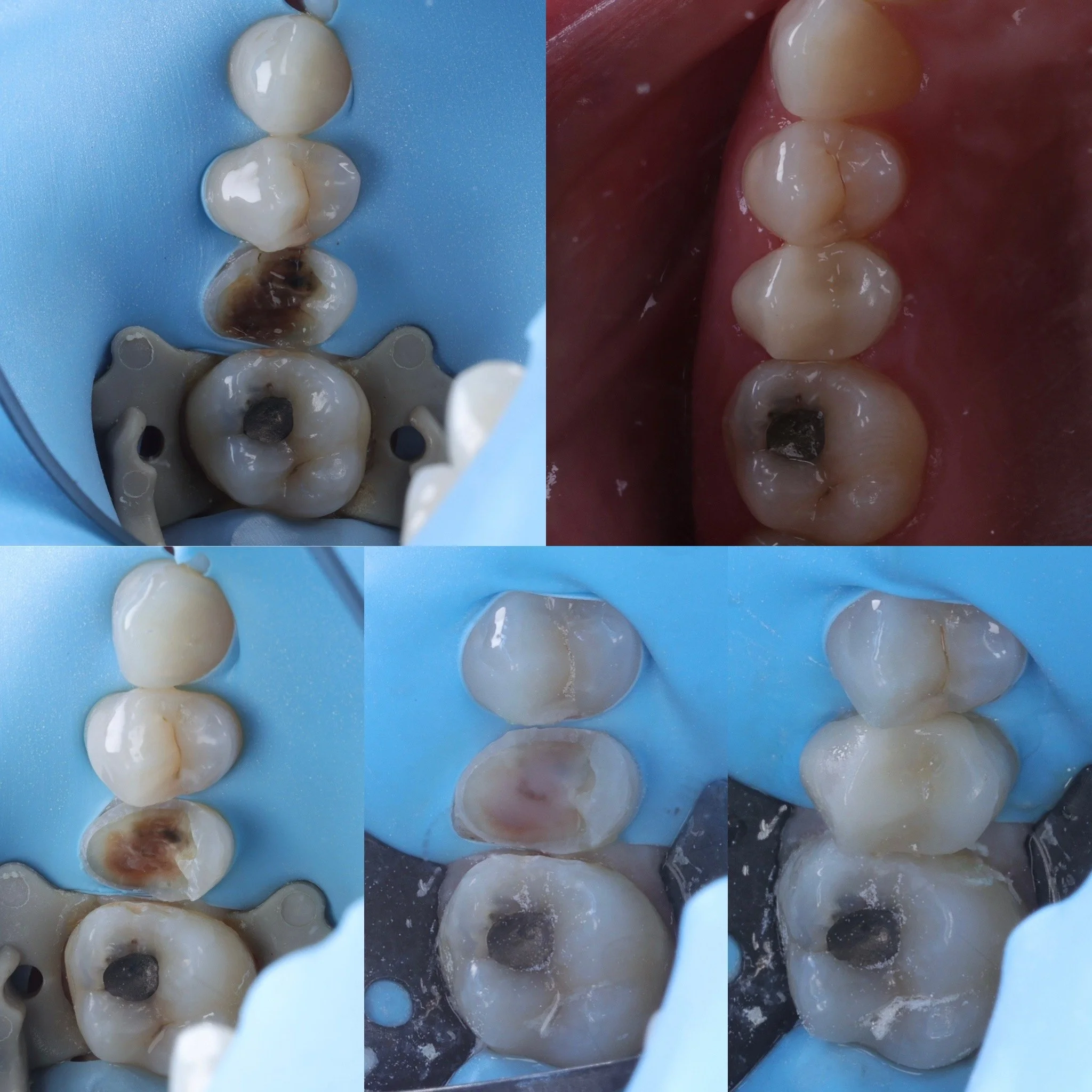 Bonded overlay and 6 month recall on fractured premolar