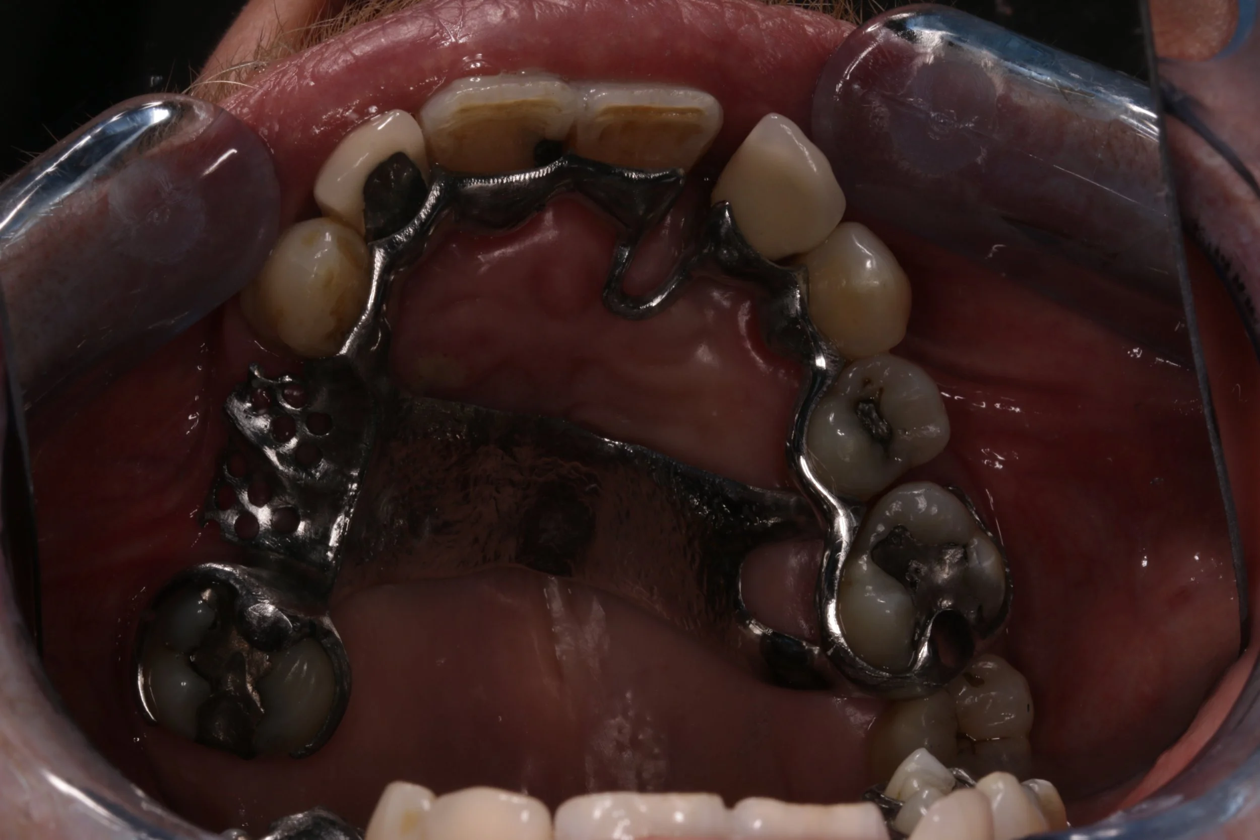 Scandinavian chrome framework try in, designed so framework not visible between UL1/2. Teeth of poor prognosis so palatal backing in case of future XLA.