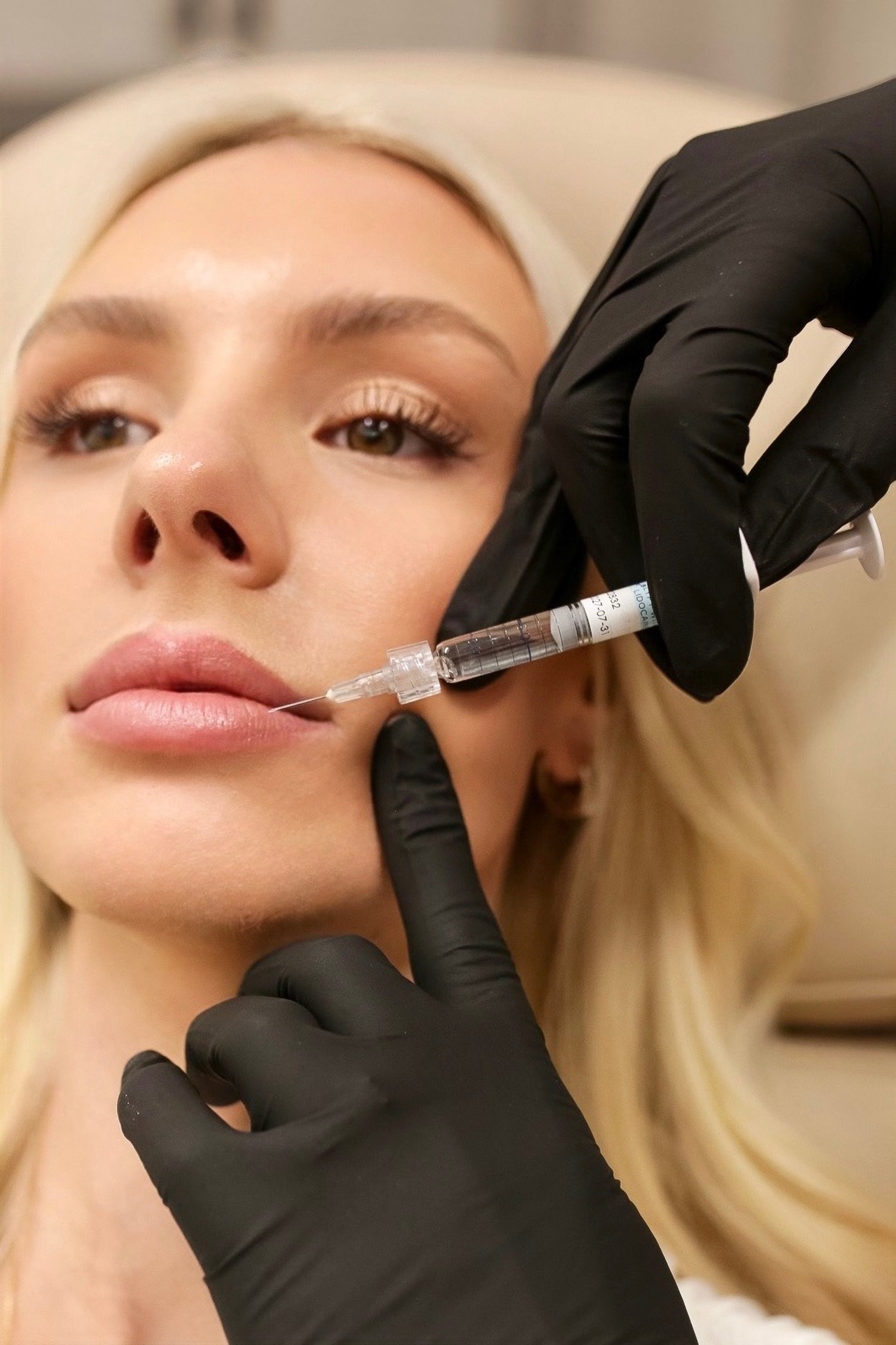 A woman receiving a cosmetic lip injection from a medical professional wearing black gloves, using a syringe.