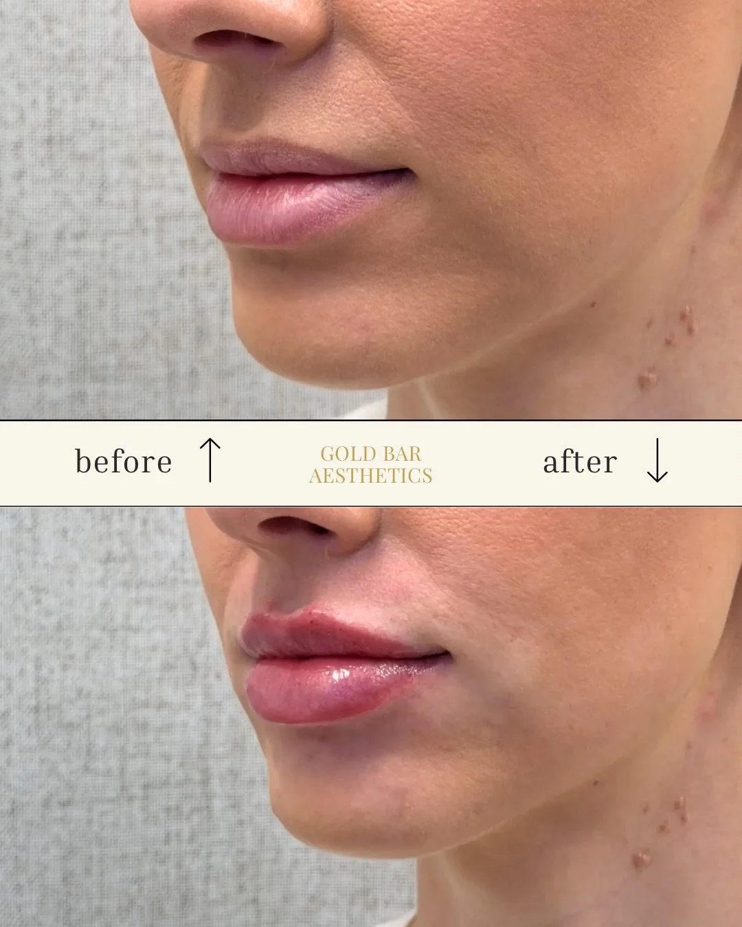 Medspa in Columbus, OH 43215 l Fillers Near Me