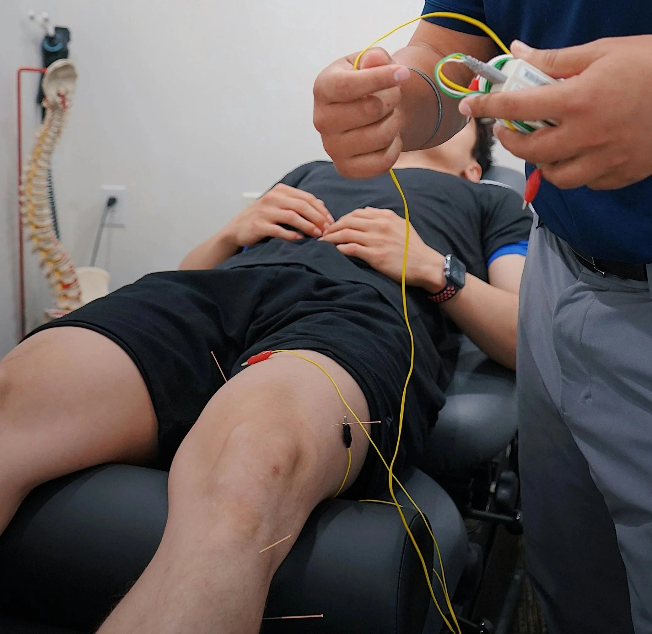 Person lying on an examination table with acupuncture needles inserted into their thigh, receiving an electro-stimulation treatment from an acupuncturist